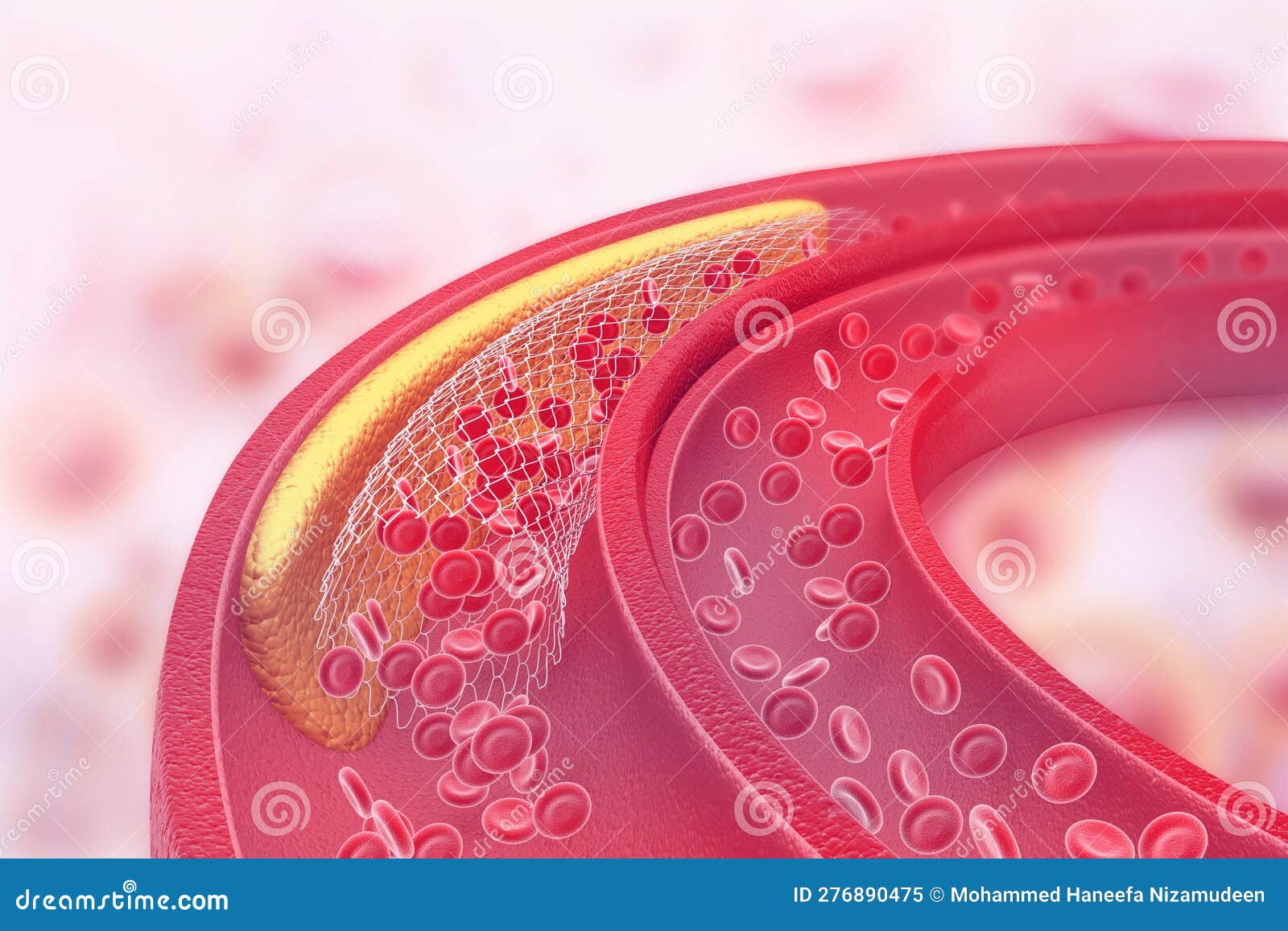 Cholesterol Plaque in Artery Stock Illustration Illustration of