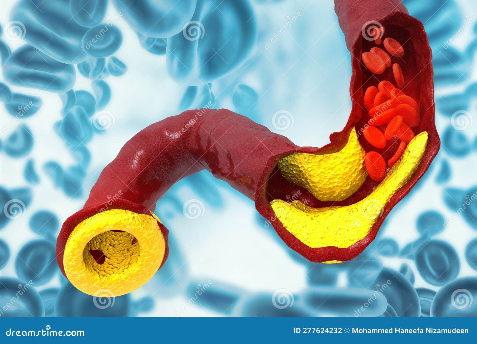 Cholesterol Plaque in Artery Stock Illustration Illustration of