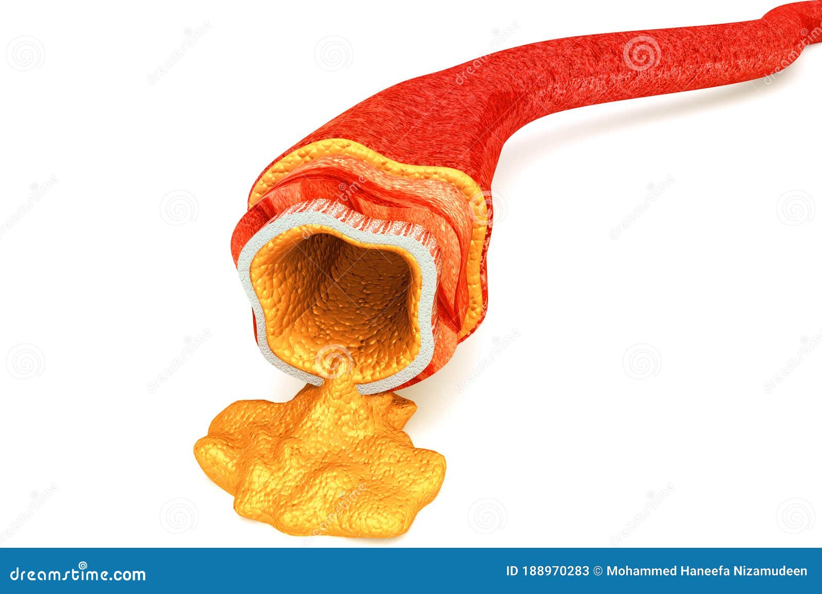 Cholesterol Plaque in Artery Stock Illustration Illustration of
