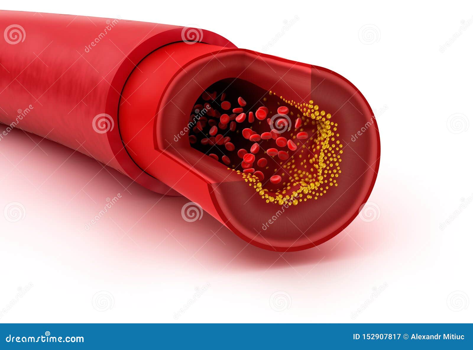 Cholesterol Plaque in Blood Vessel Stock Illustration Illustration of
