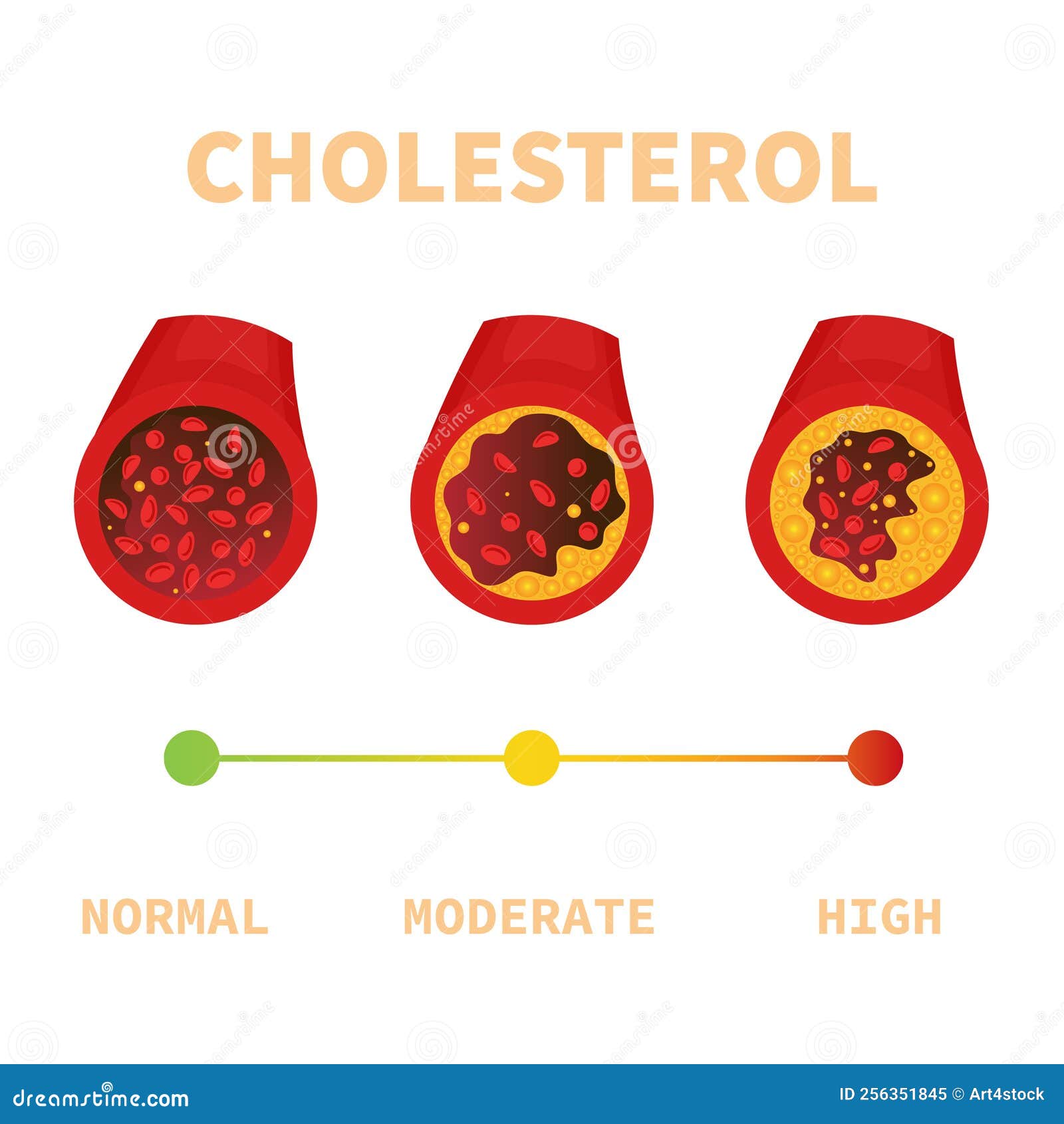 cholesterol plaque in blood vessel medical diagram