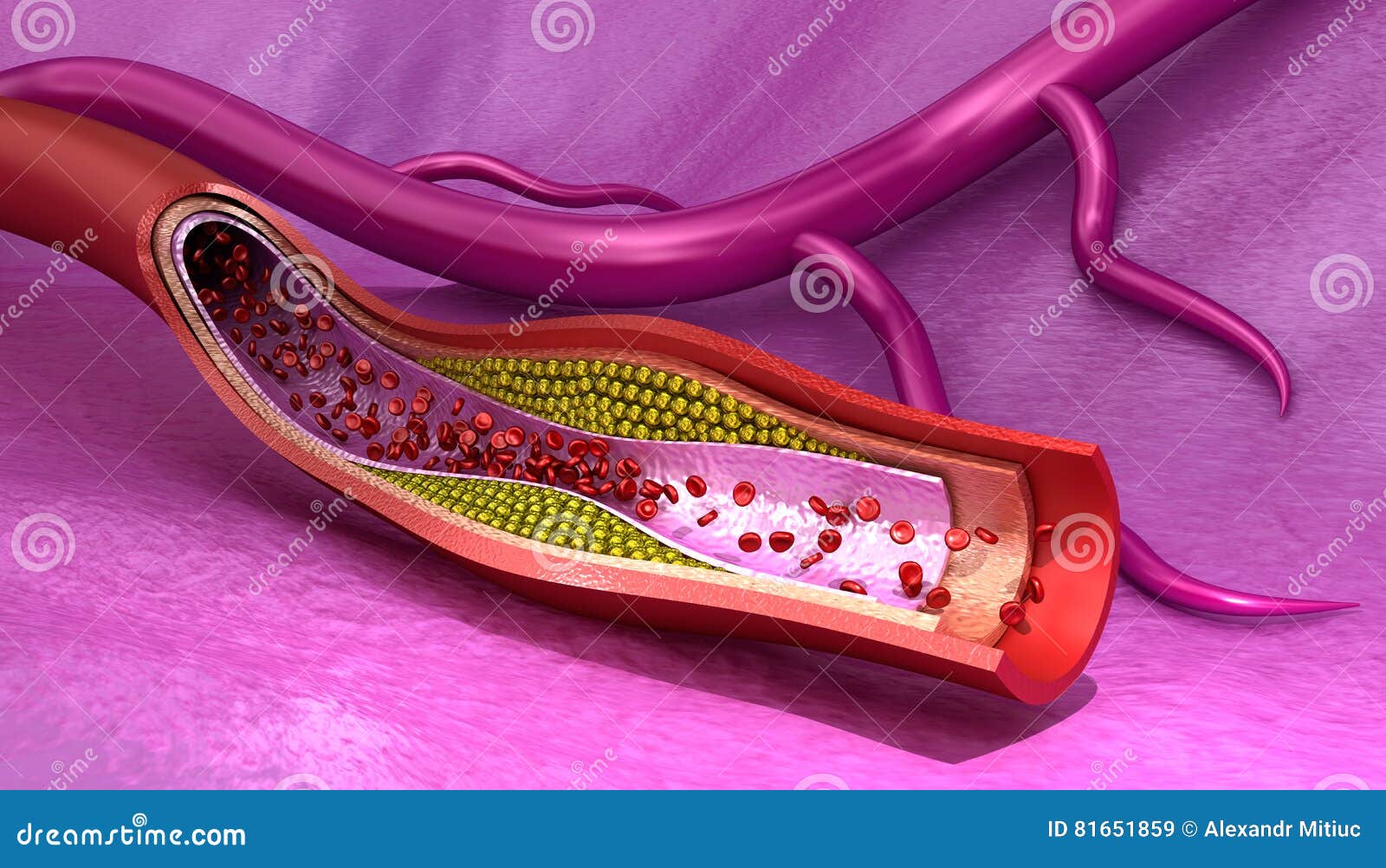 Cholesterol Plaque in Blood Vessel , Medically Accurate Stock
