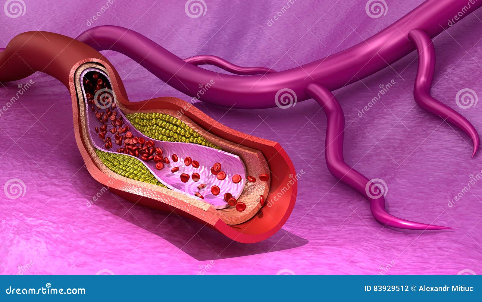 Cholesterol Plaque In Artery Cartoon Vector 16071279