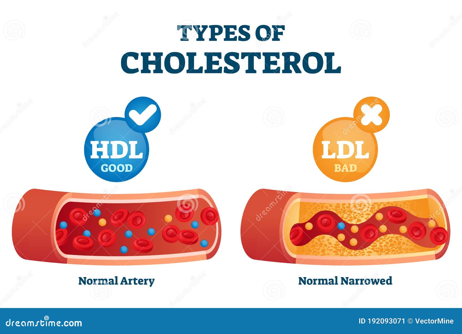 Cholesterol Types Comparison With Hdl And Ldl Lipoprotein Vector Illustration Stock Illustration Illustration Of Explanation Cardiovascular Cholesterol Types Comparison With Hdl And Ldl Lipoprotein Vector Illustration Stock Illustration Illustration Of Explanation Cardiovascular