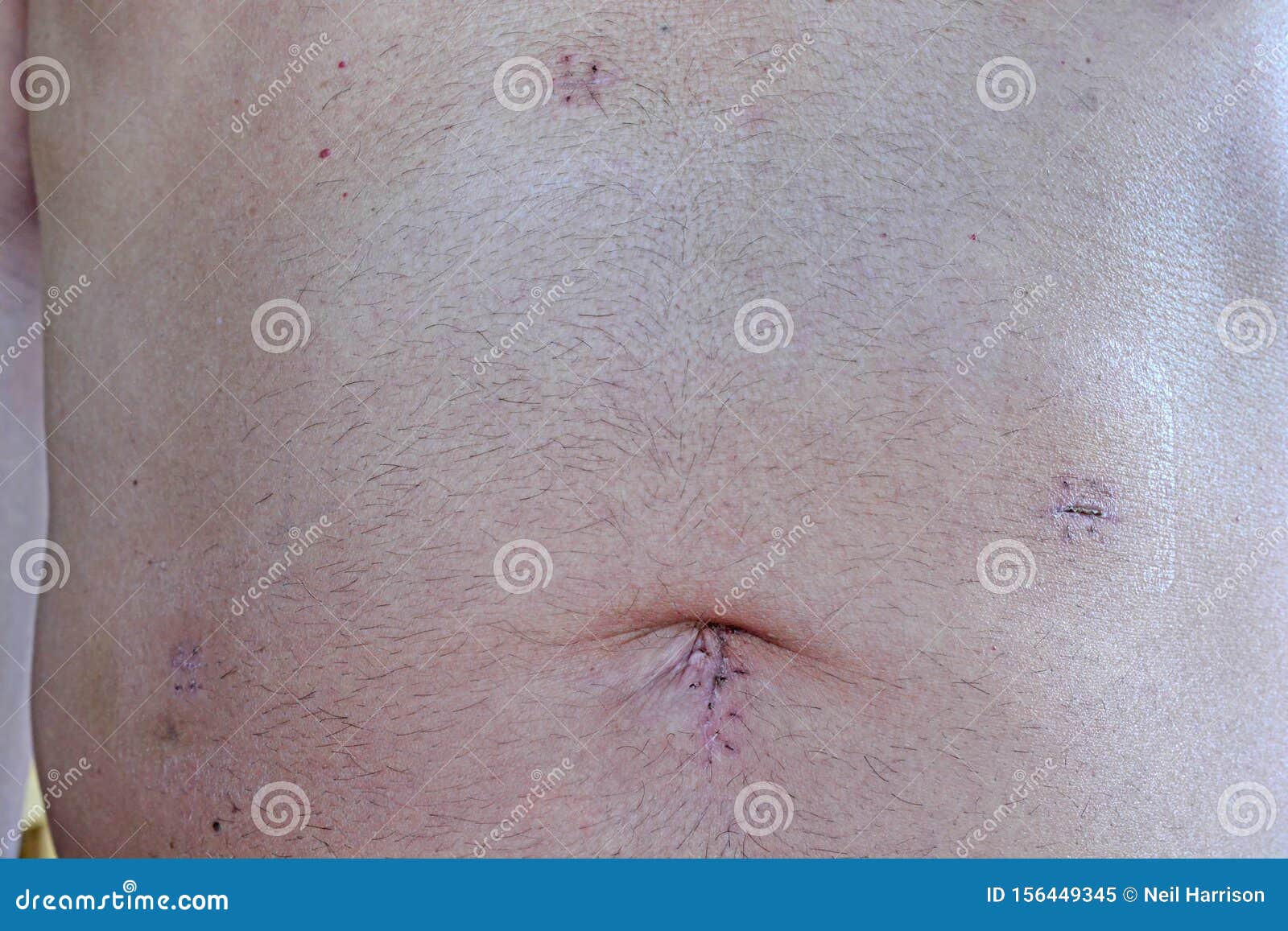 Cholocystectomie image stock. Image du chirurgie, peau - 156449345