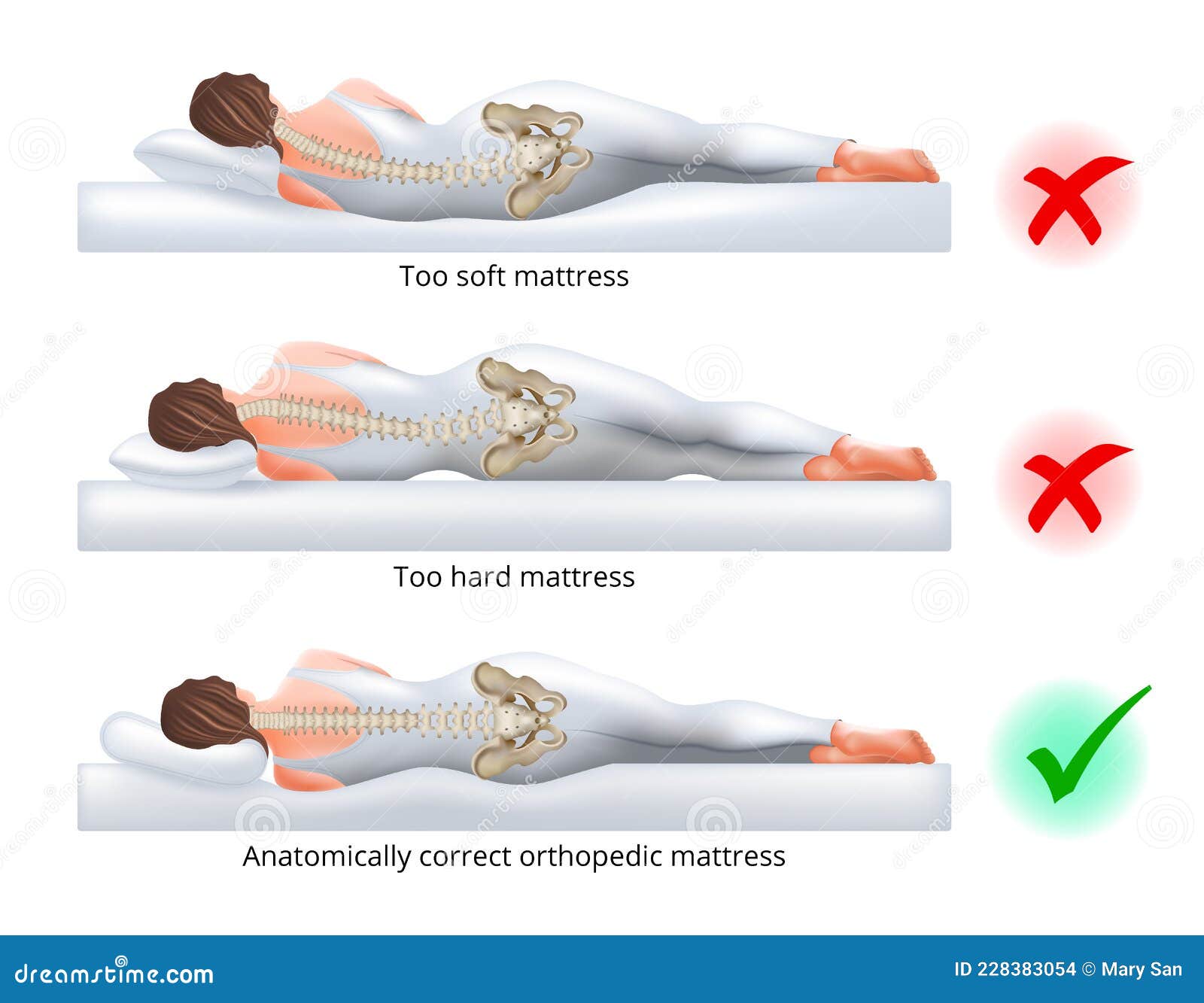 choosing an orthopedic mattress for sleeping - correct and incorrect sleeping position on the side,  .