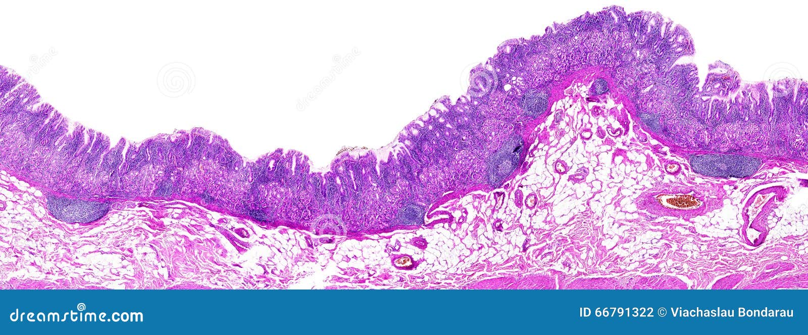 chronic gastritis of a human