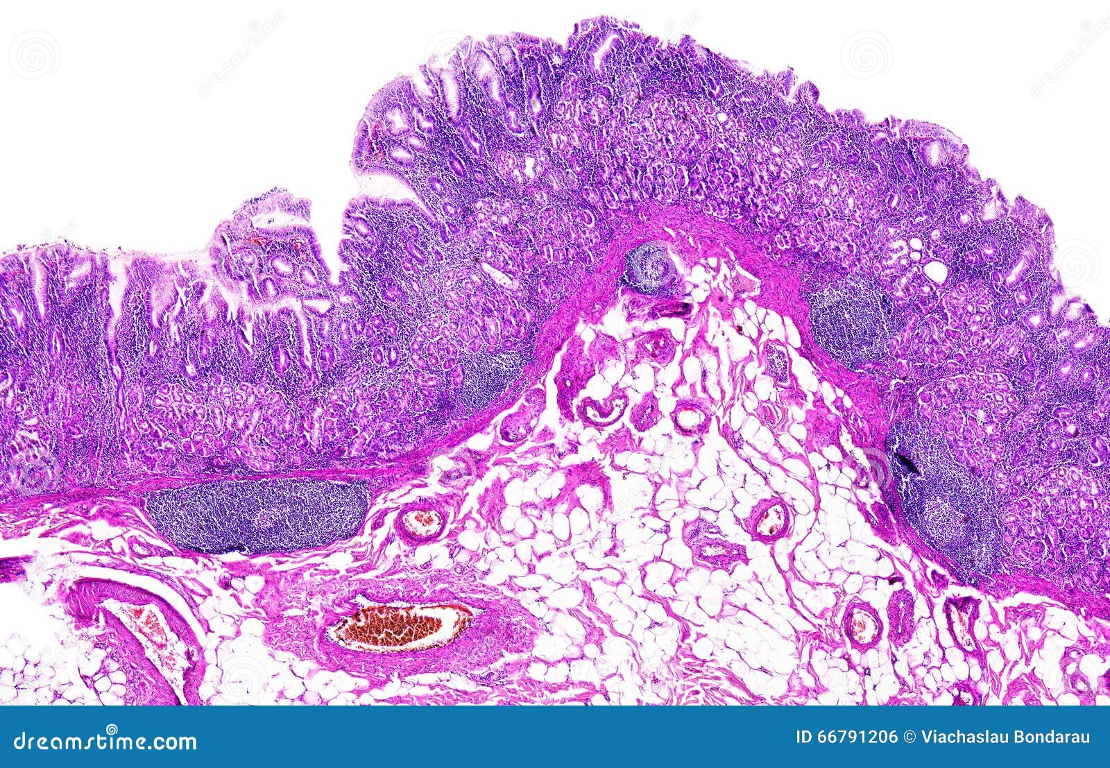 chronic gastritis of a human