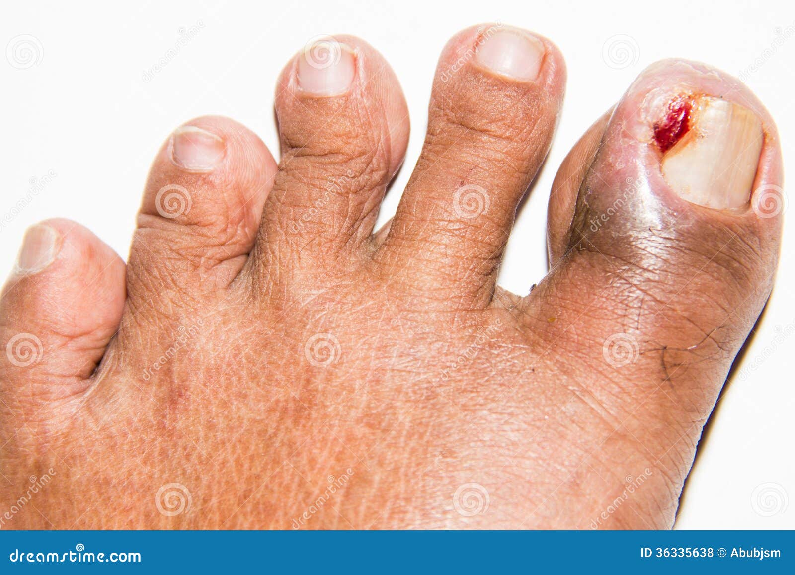 What causes an ingrown toenail?