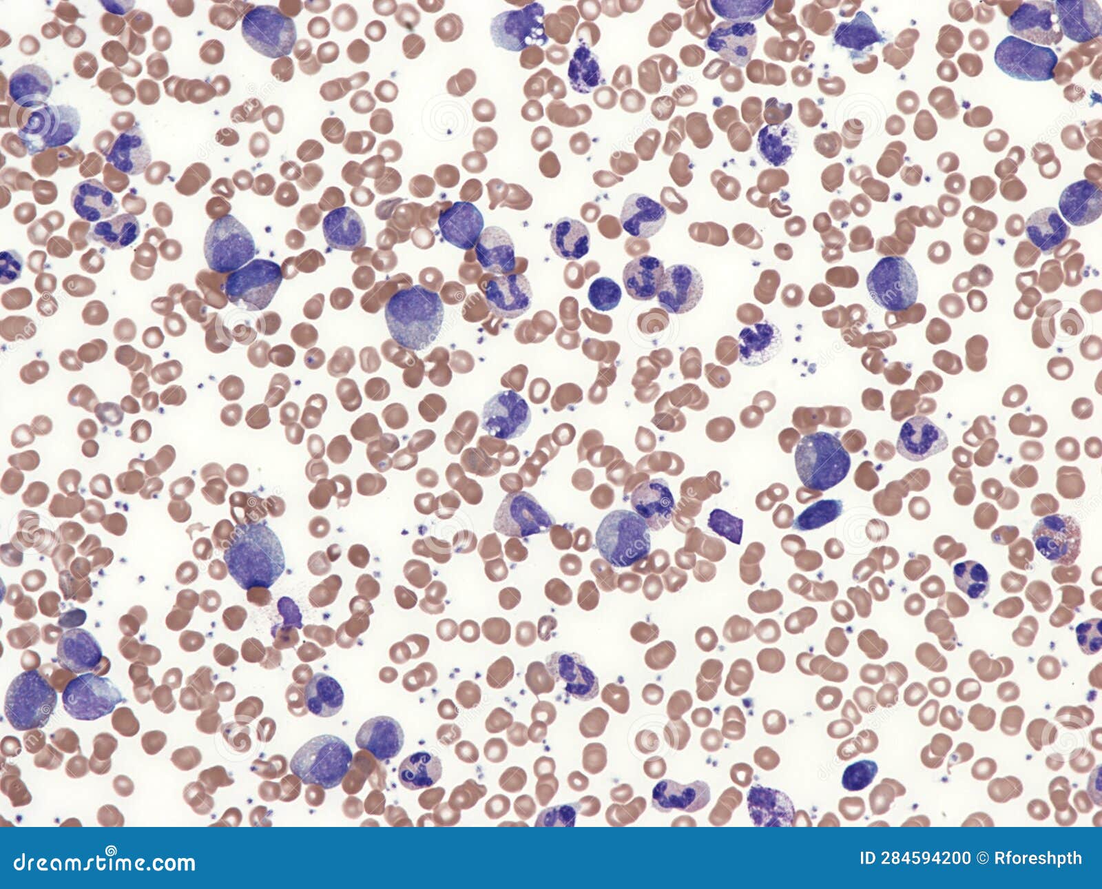 chronic myelogenous leukemia.