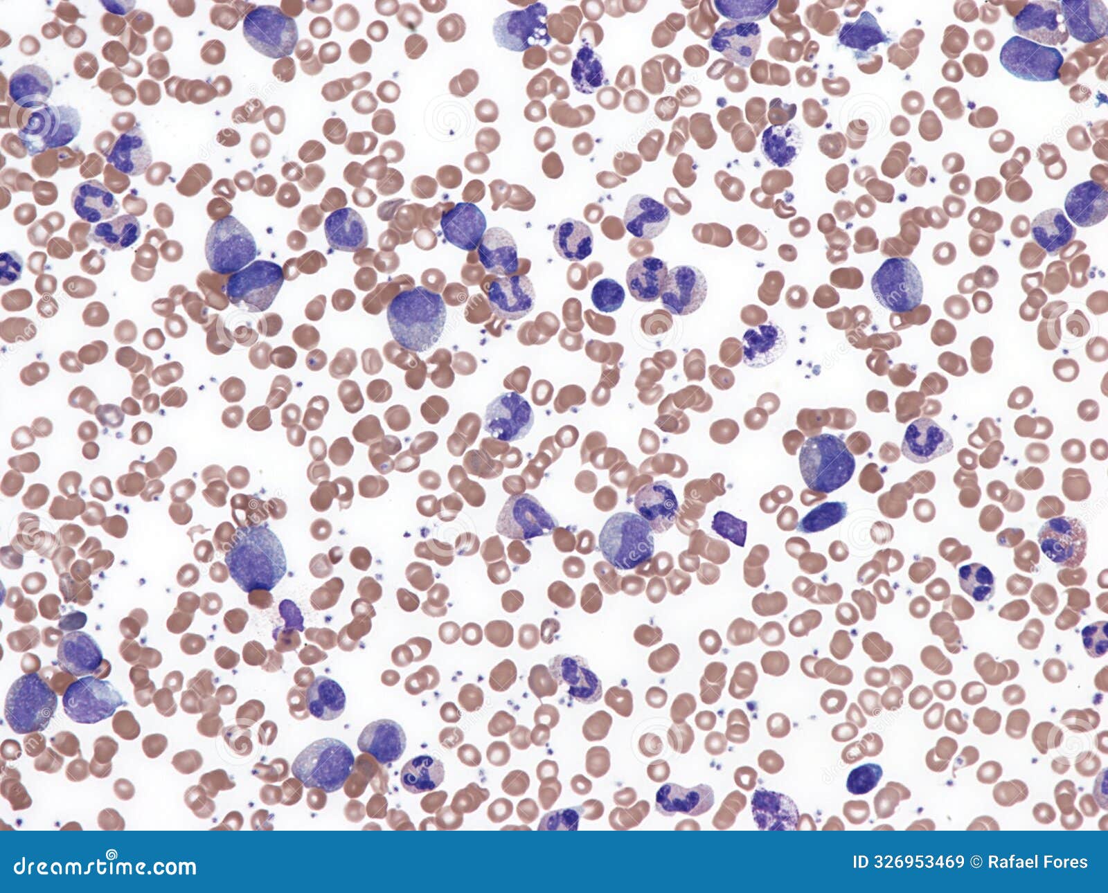 chronic myeloid leukemia in a child, peripheral blood