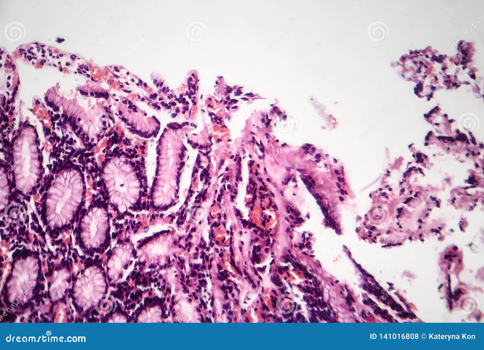 Histopatologia chroniczny atroficzny gastritis, lekki micrograph, fotografia pod mikroskopem