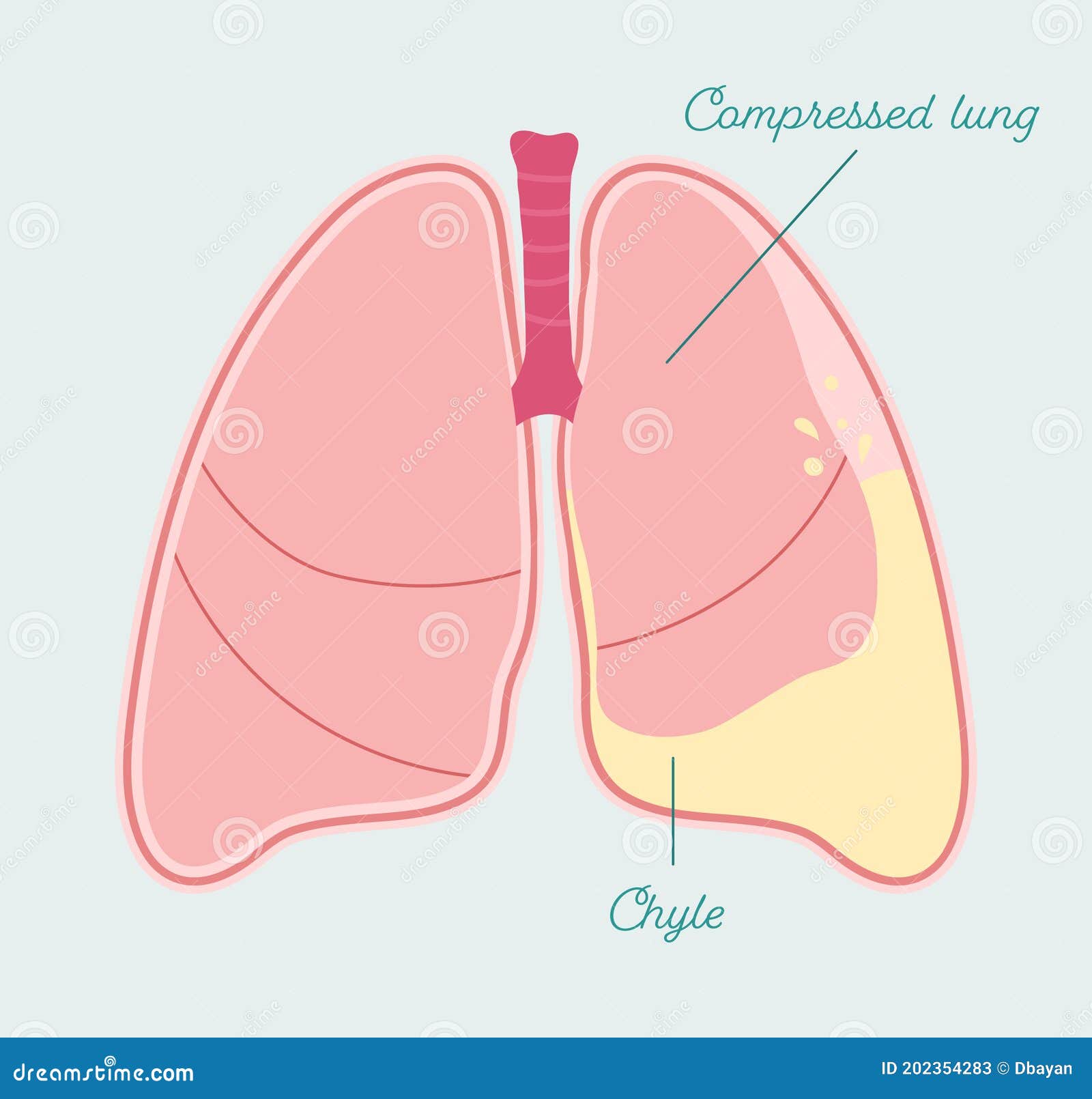 chylothorax in human lung. accumulation of lymph in pleural space -  anatomical scheme