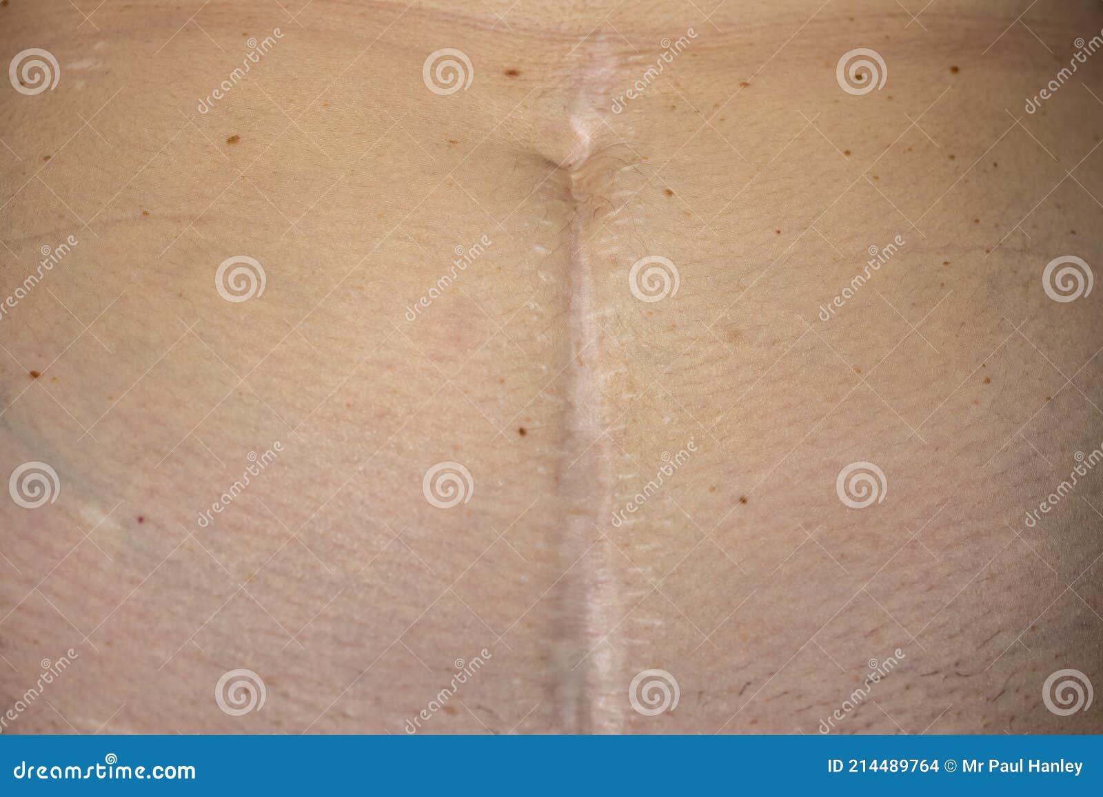 Cicatrice D'une Appendicectomie D'urgence Et D'une Chirurgie D ...