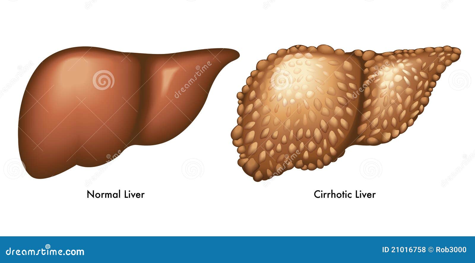 cirrhosis