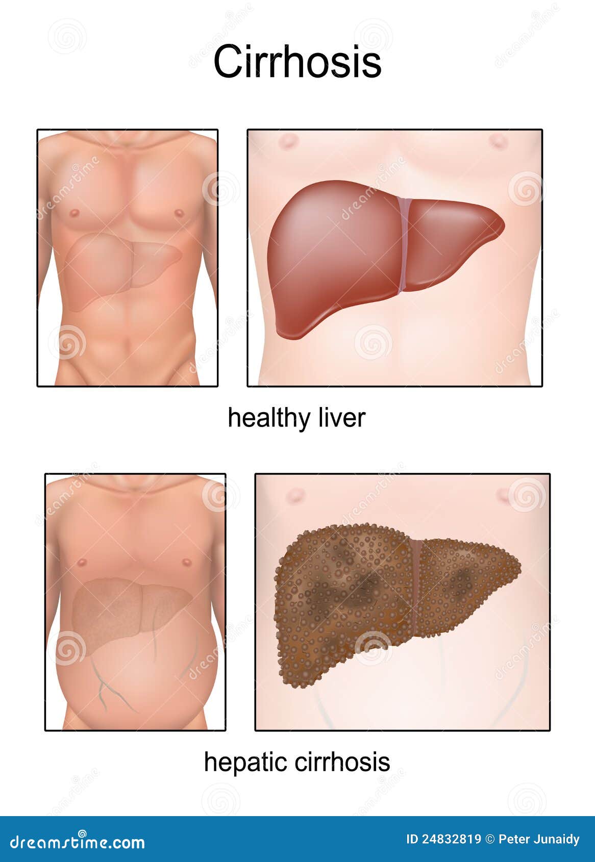 cirrhosis.