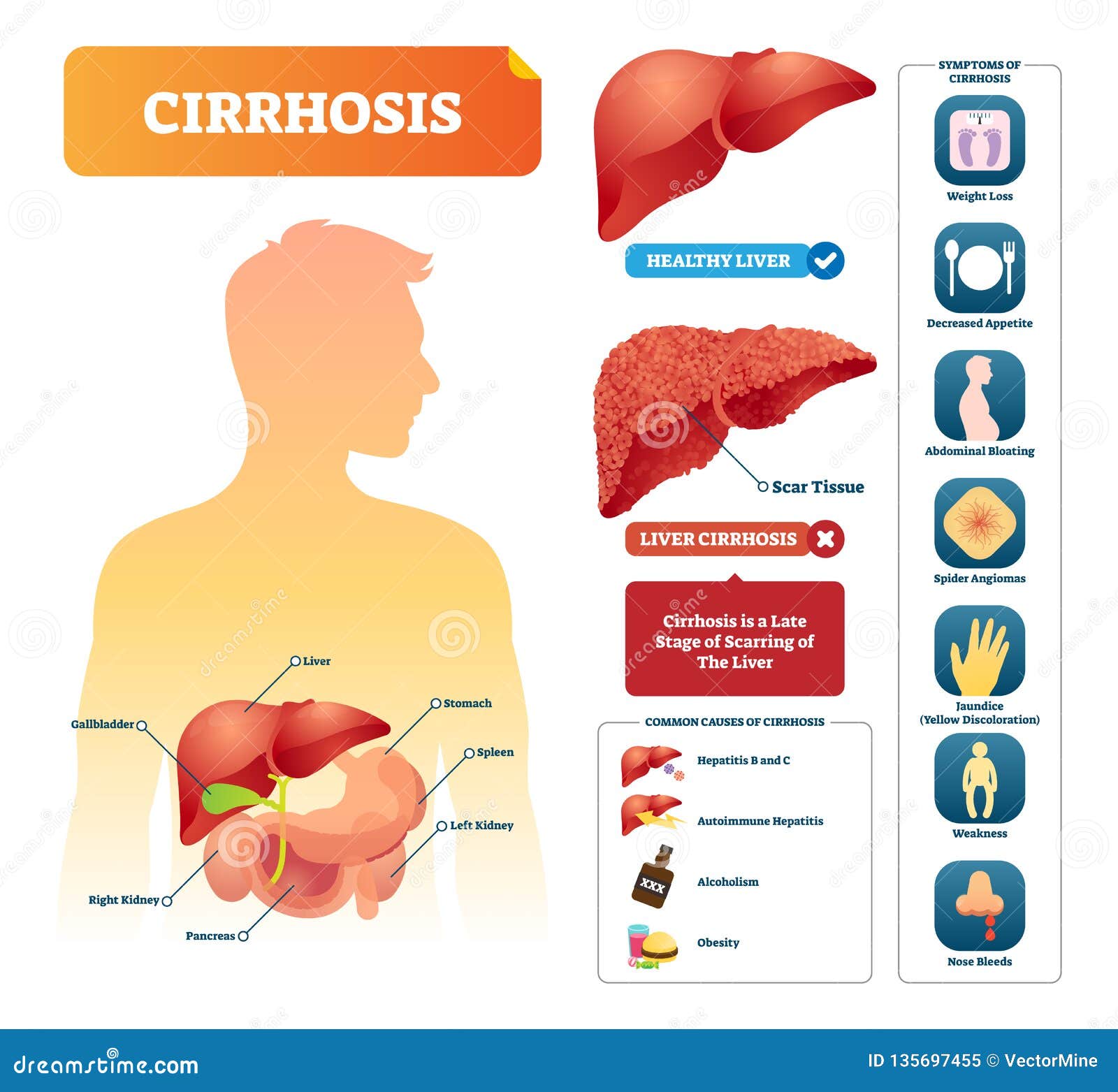 Cirrhosis Vector Illustration. Labeled Medical Diagram with Illness ...