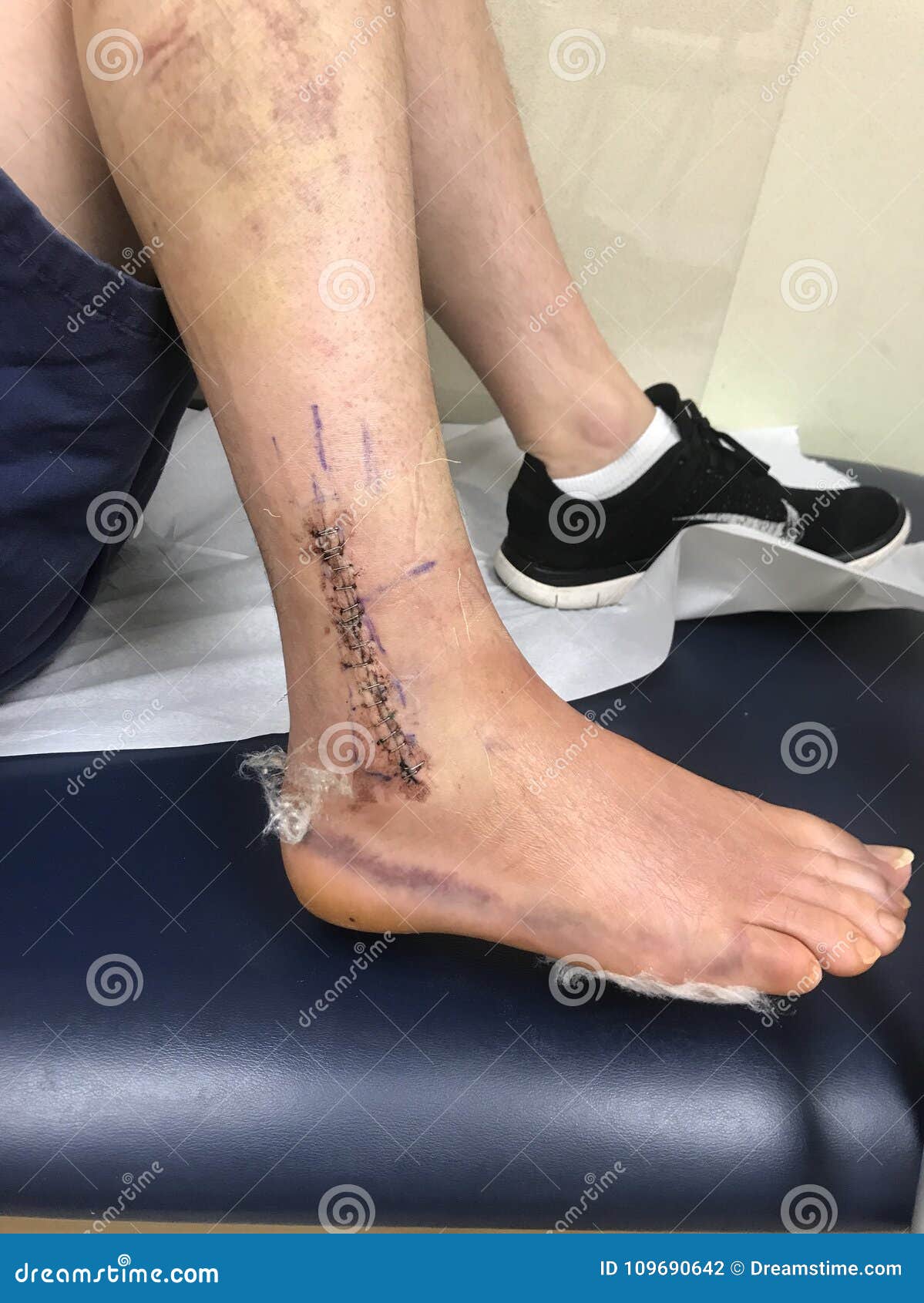 Cirugía del tobillo foto de archivo. Imagen de cicatriz 109690642