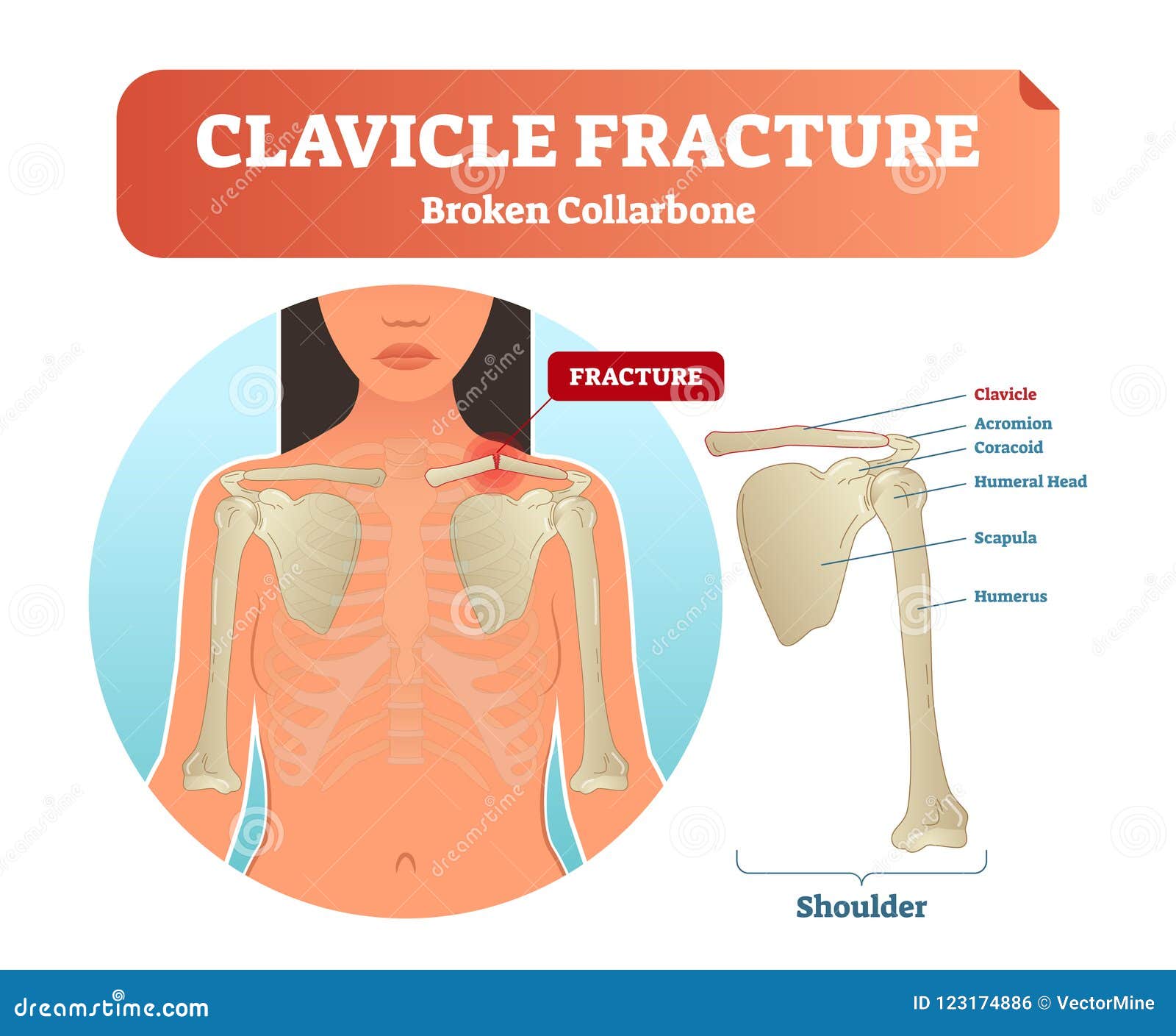 clavicle fracture with broken collarbone  . medical and anatomical labeled scheme with clavicle fracture.