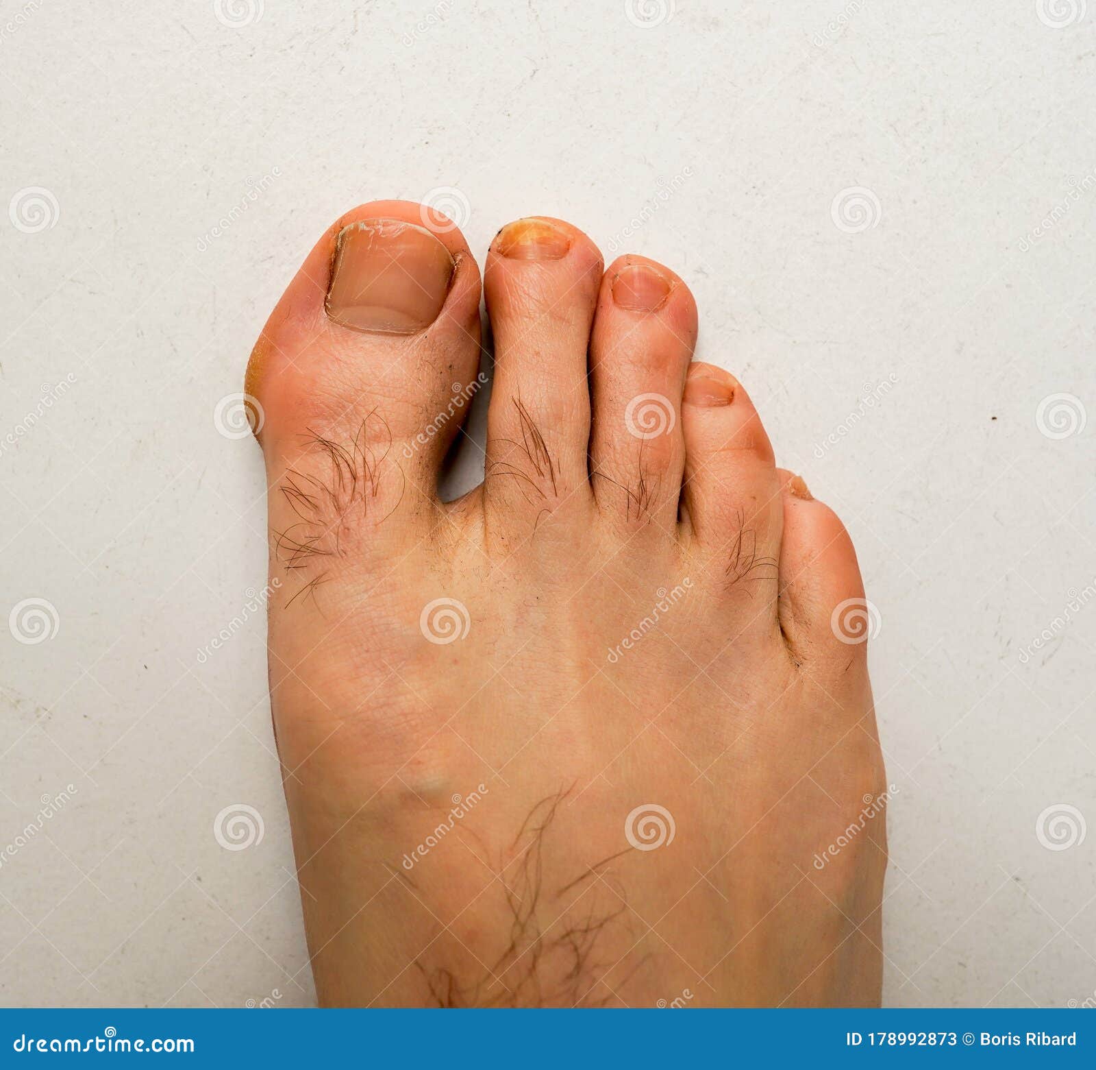 Clavo De Pie Humano Roto Y No Sano Imagen de archivo Imagen de gente