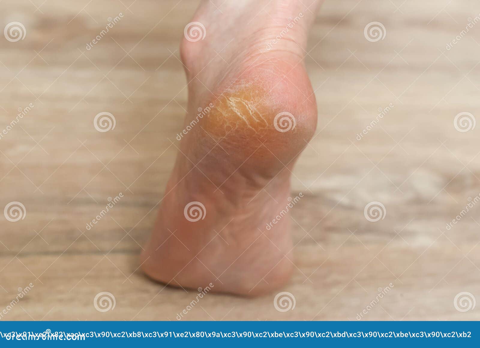 Clavus and Cracks on the Heel of the Foot Stock Photo Image of cracks