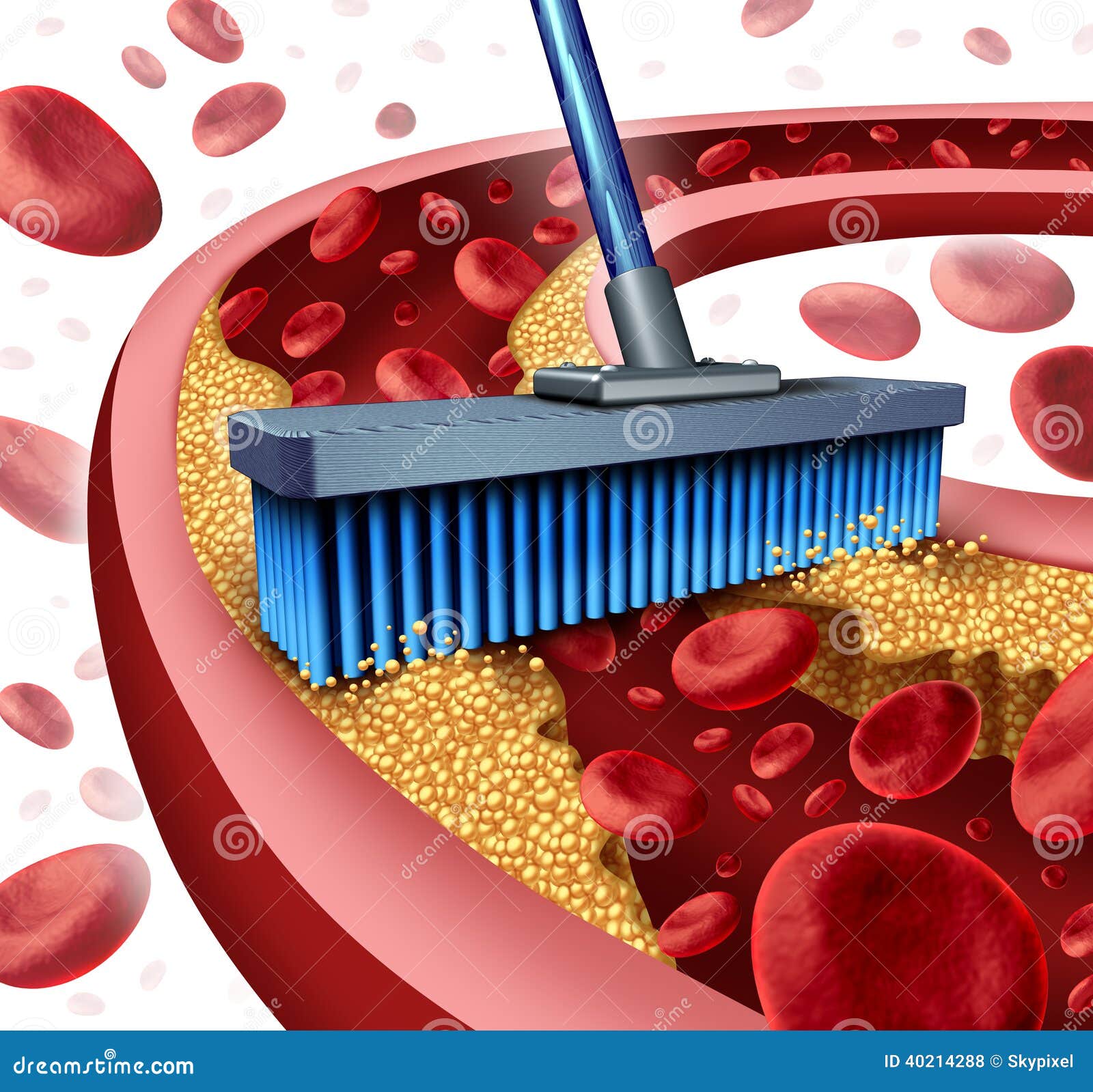 cleaning arteries