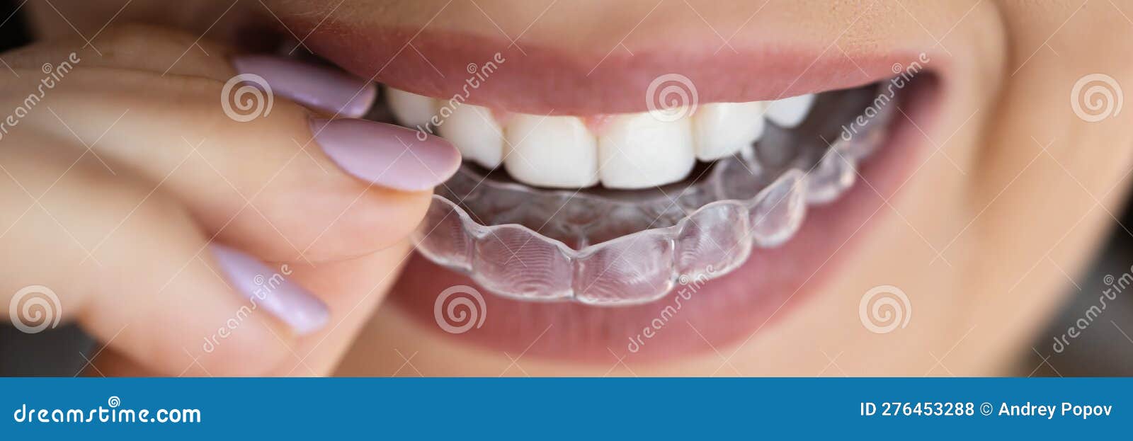 Clear Aligner Dental Night Guard Stock Photo Image of orthodontic