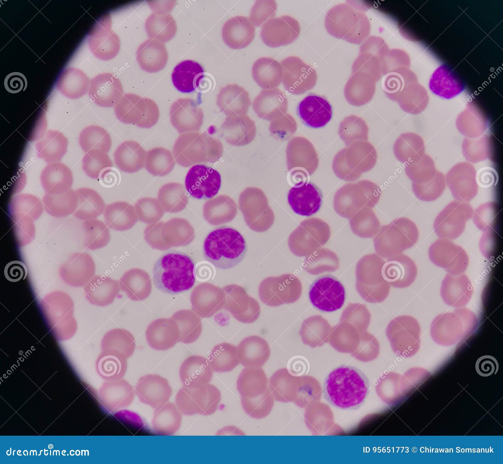 CLL blood smear stock image. Image of infection, blood 95651773