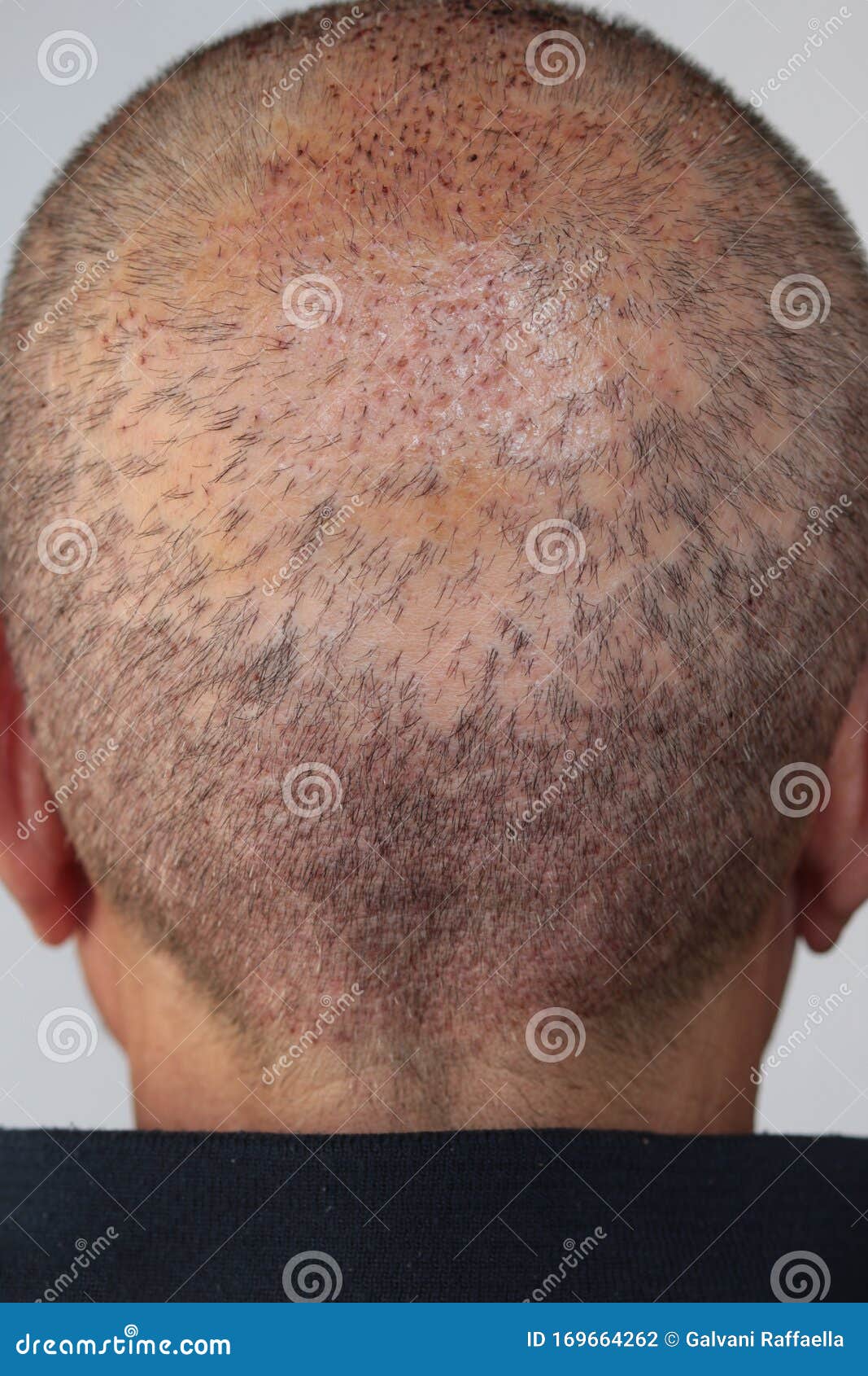 Close Back Man`s Head Who Has Done a Self Hair Transplant Stock Photo -  Image of health, caucasian: 169664262