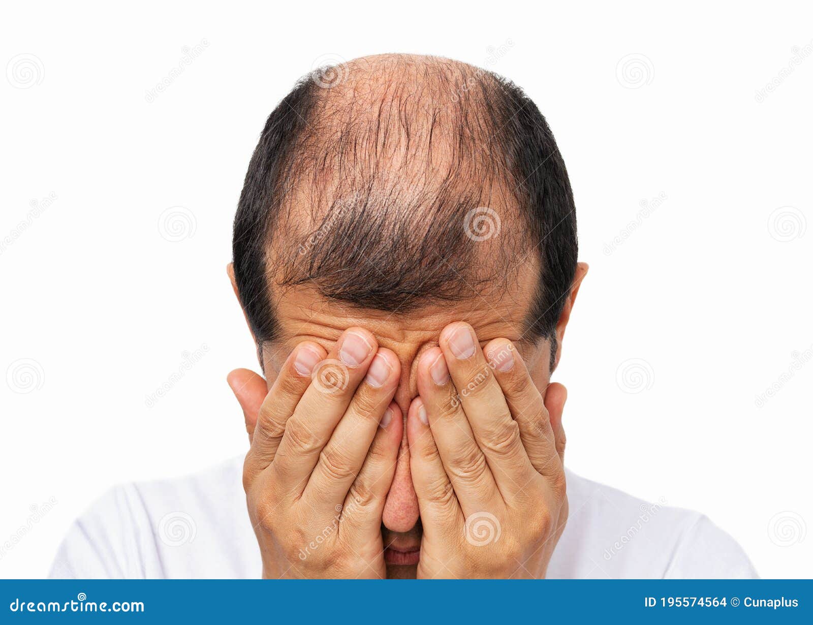 Bald Man Stressed by Rapid Hair Loss Stock Photo - Image of crying, afraid:  195574564