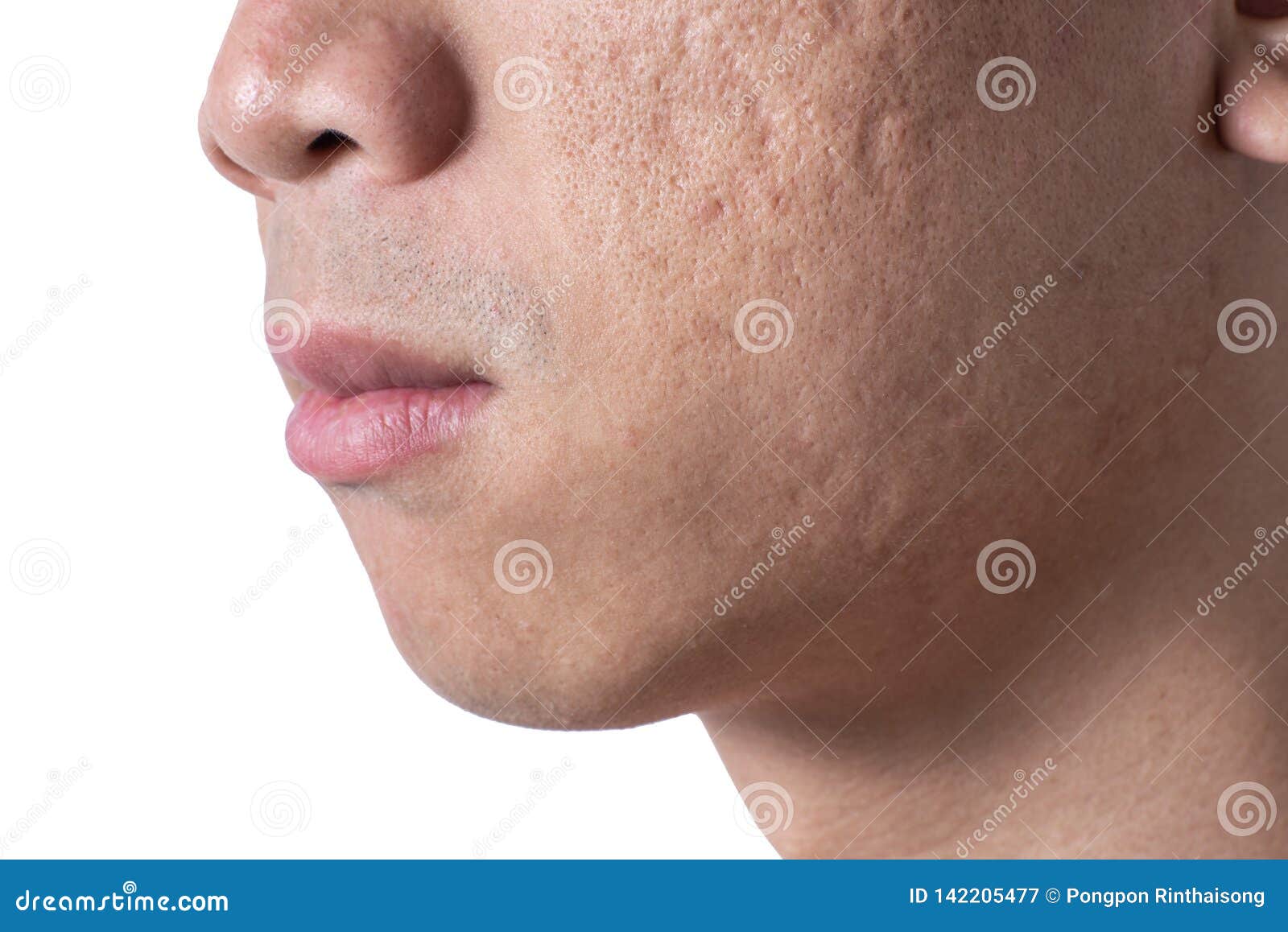 close-up acne and scars on asian man face