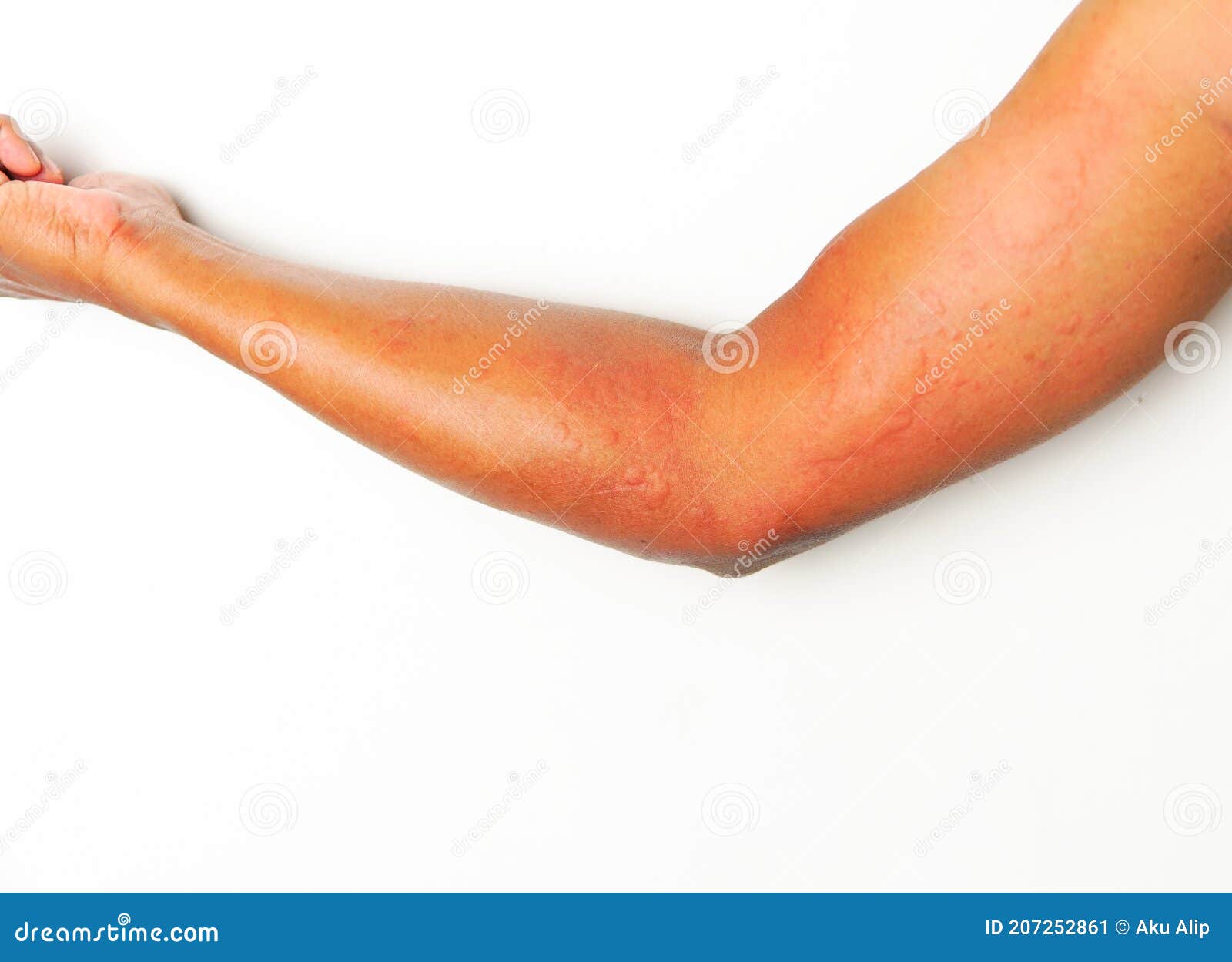 Close Up Allergy Rash On Sensitive Skin Stock Image Image Of Hand