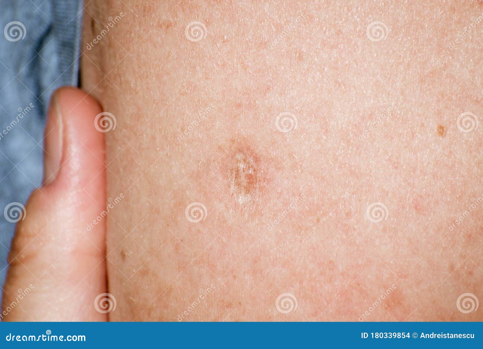 close up of bacillus calmette-guÃÂ©rin bcg vaccine scar mark in the upper left arm of an adult person; bcg vaccine is usually