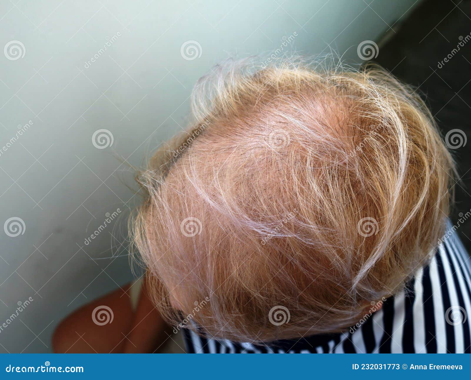 Close Up Of A Balding Woman`s Head Stock Image Image Of Problem Help