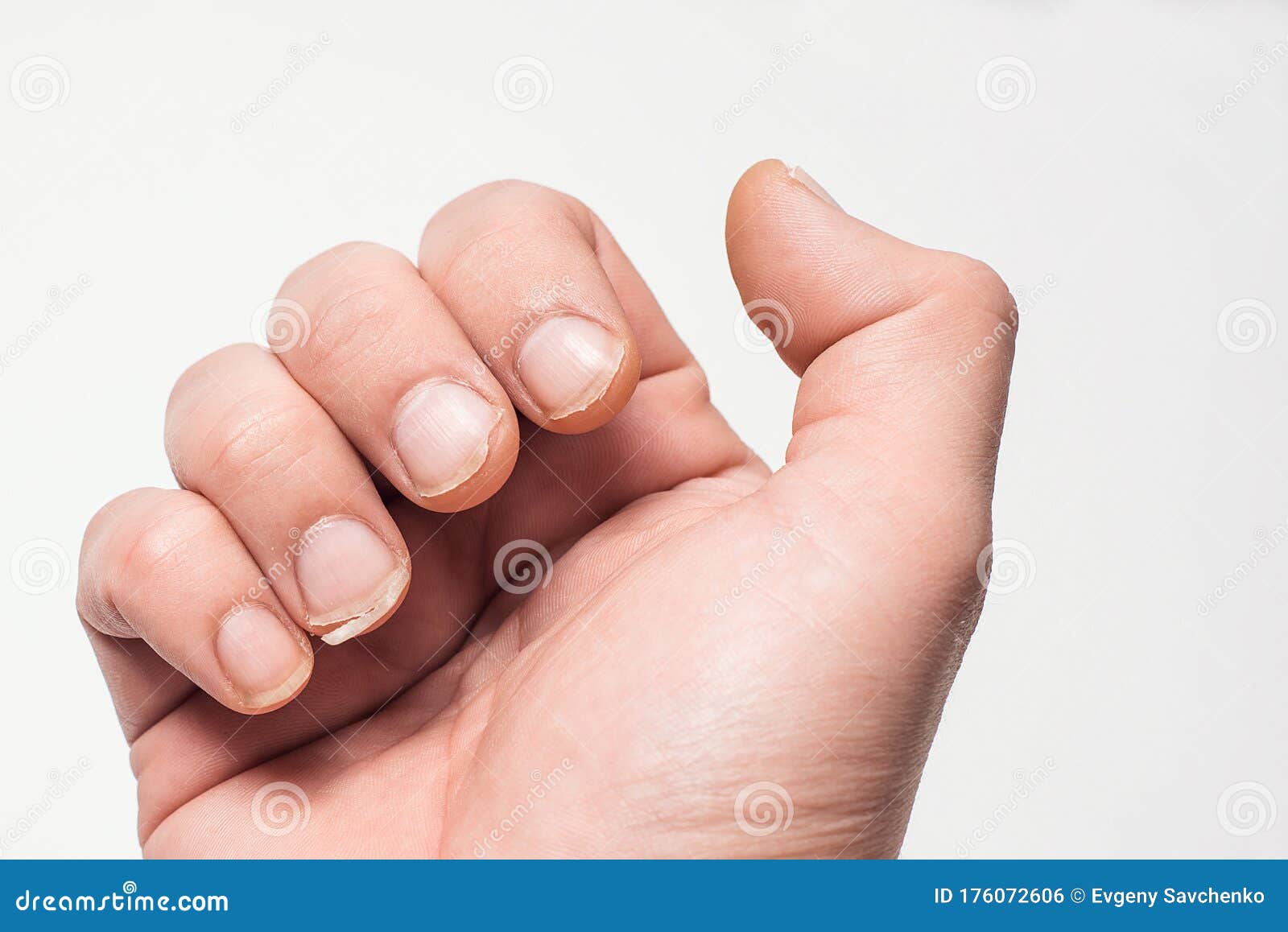 279 Brittle Nails Stock Photos - Free & Royalty-Free Stock Photos from  Dreamstime