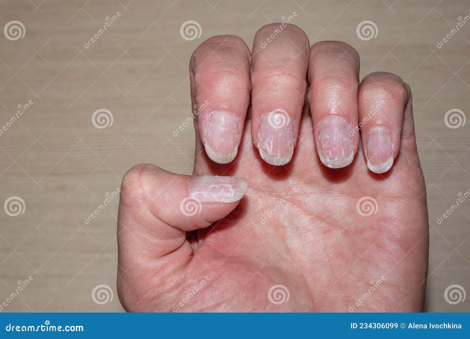 close up bitten brittle nails manicure macro photo vertical ridges fingernails overgrown cuticle fingernails 234306099