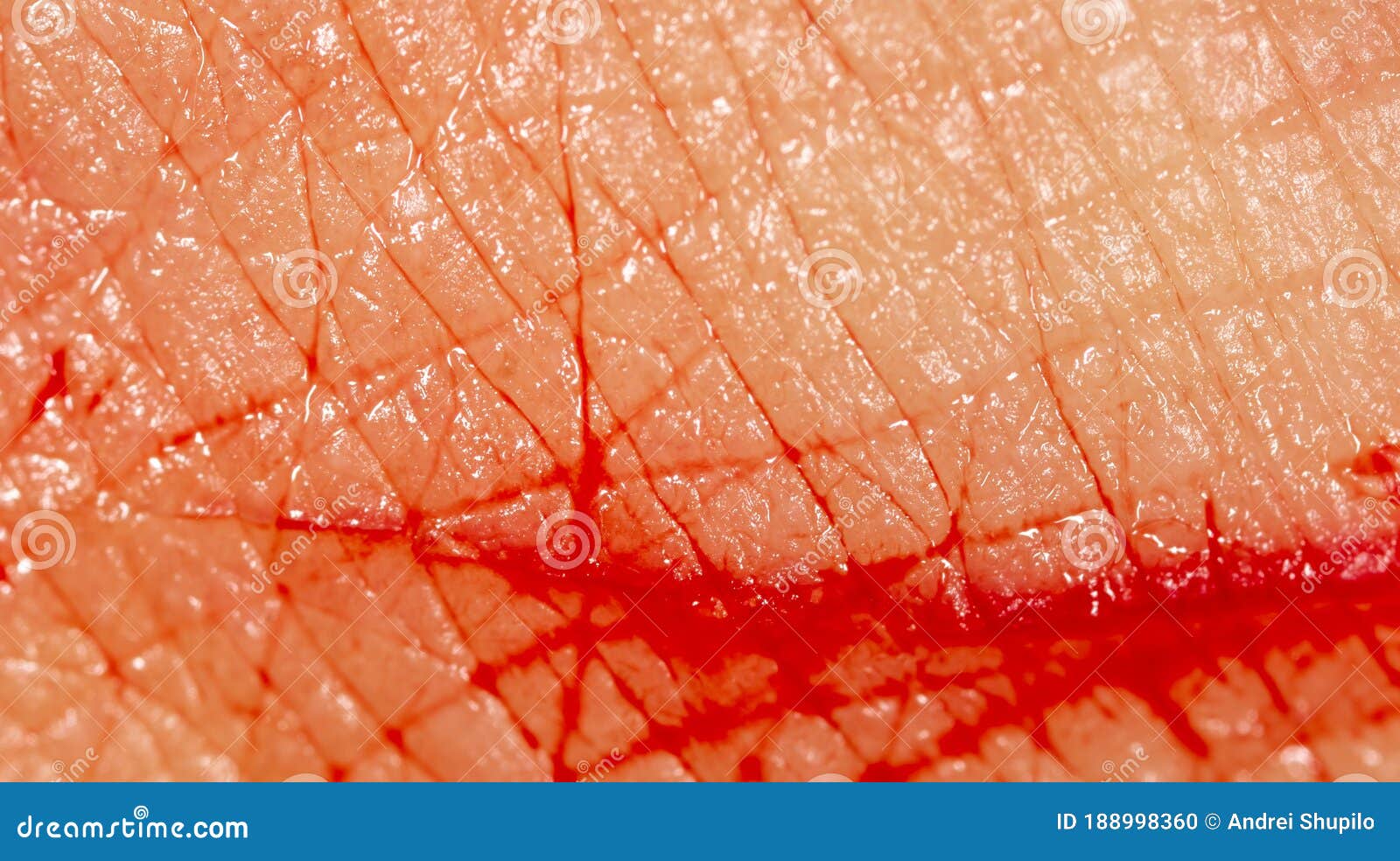 Closeup of Blood from a Wound on a Human Skin Stock Photo Image of healthcare, wound 188998360