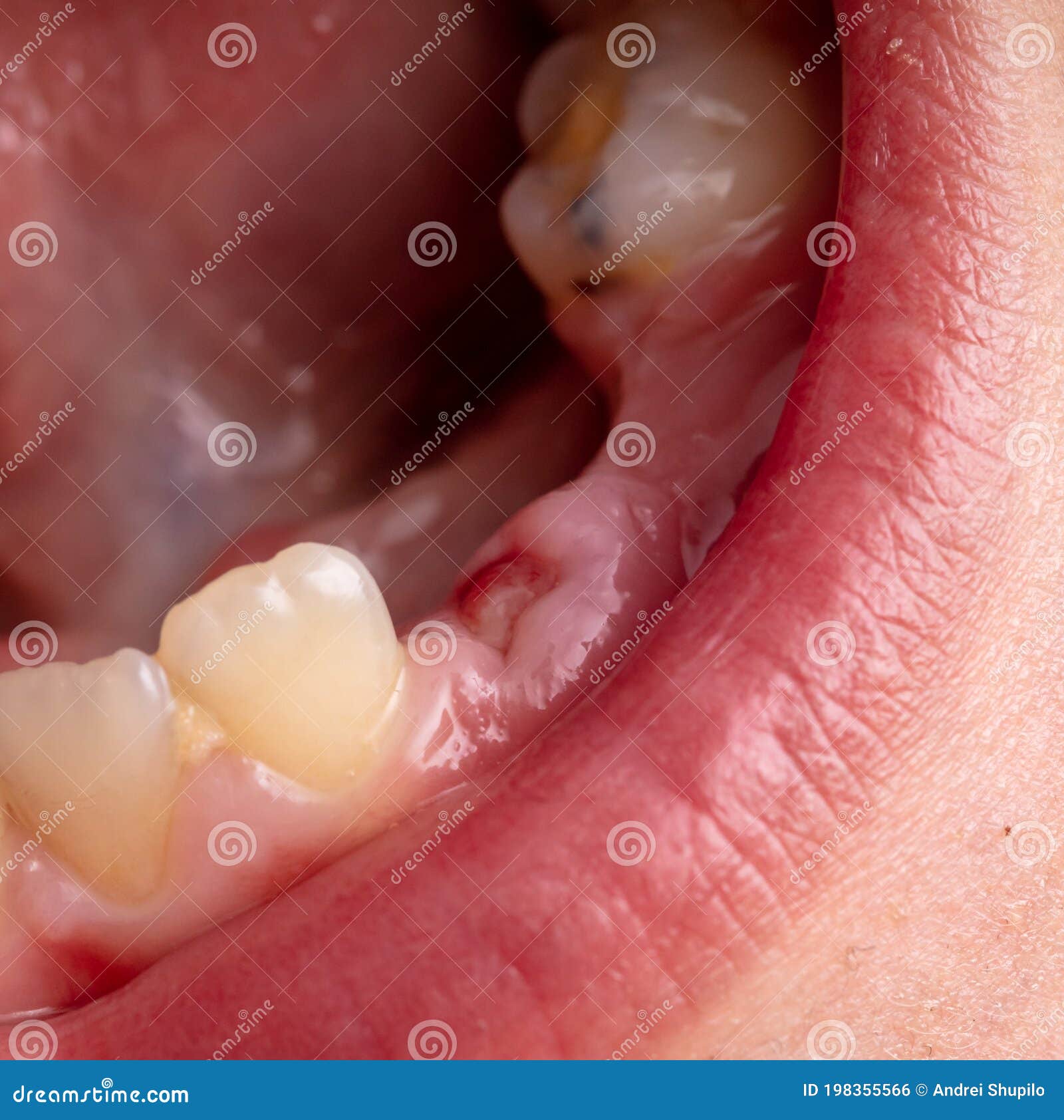 Close-up of a Boy S Milk Tooth Fell Out Stock Photo - Image of white