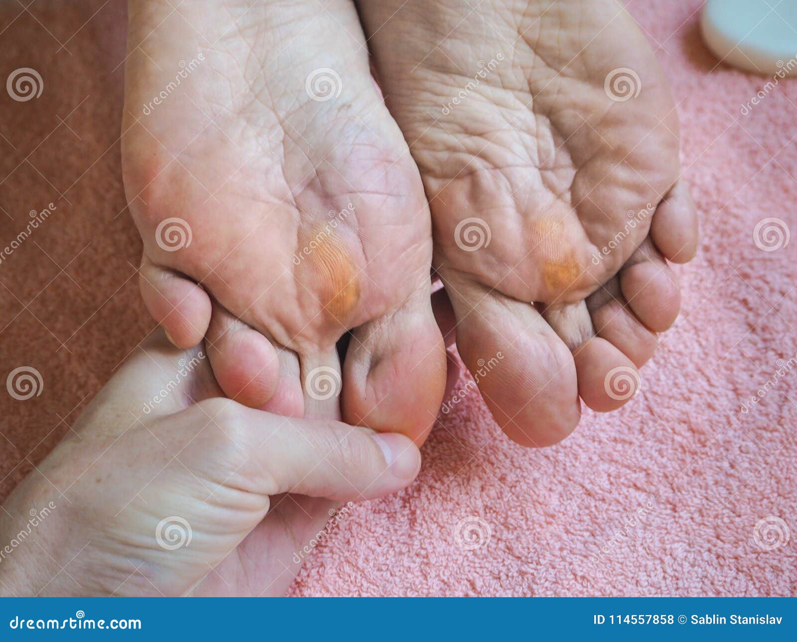 Close Up of Calluses. Painful Corn on Foot. Stock Photo Image of body