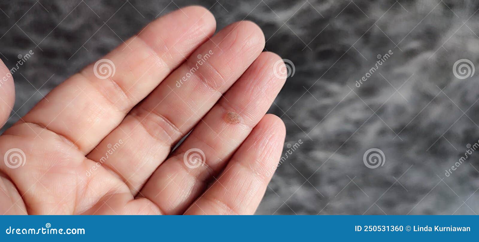 Close Up of Clavus or Corn on Finger. Dermatology Problem Stock Photo