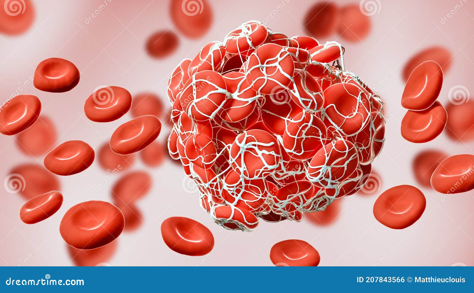 Close-up a Coagulated Clot of Red Blood Cells Entangled in Fibrin 3D Rendering Thrombus, Thrombosis, Blood Stock - Illustration of fibrin, disease: