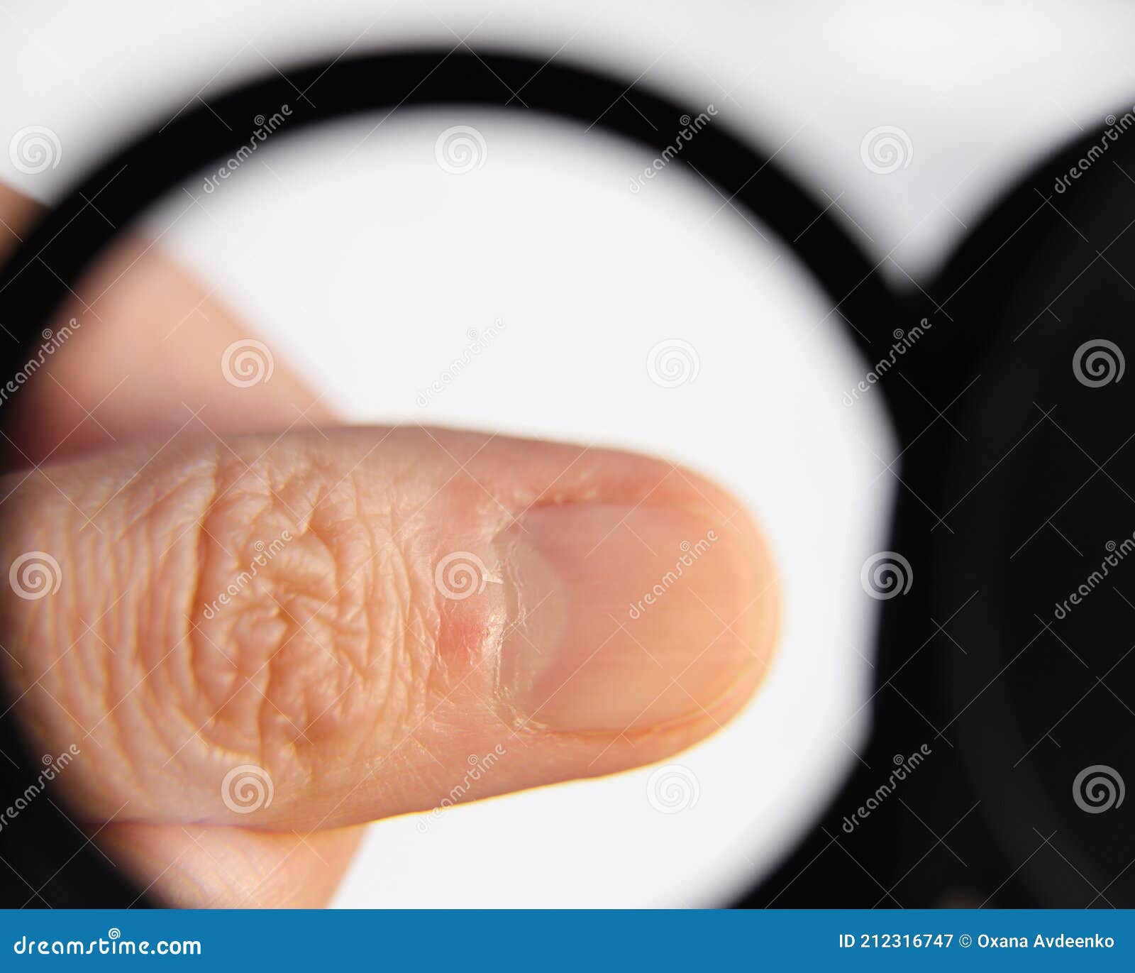 close-up of dead thin skin at the base of the nails on the fingers.