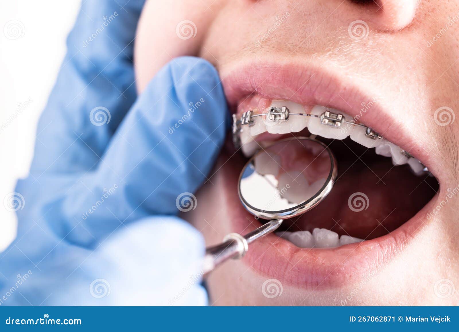 A Close-up of a Dental Brace, a Dentist-orthodontist Checks the Tension