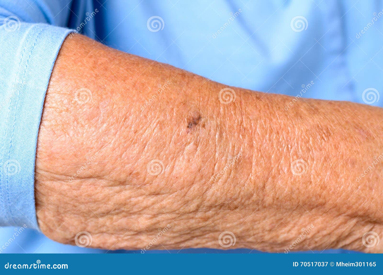 Close Up Detail Of The Forearm Of An Elderly Woman Stock Image Image Of Wart Stain Close Up Detail Of The Forearm Of An Elderly Woman Stock Image Image Of Wart Stain