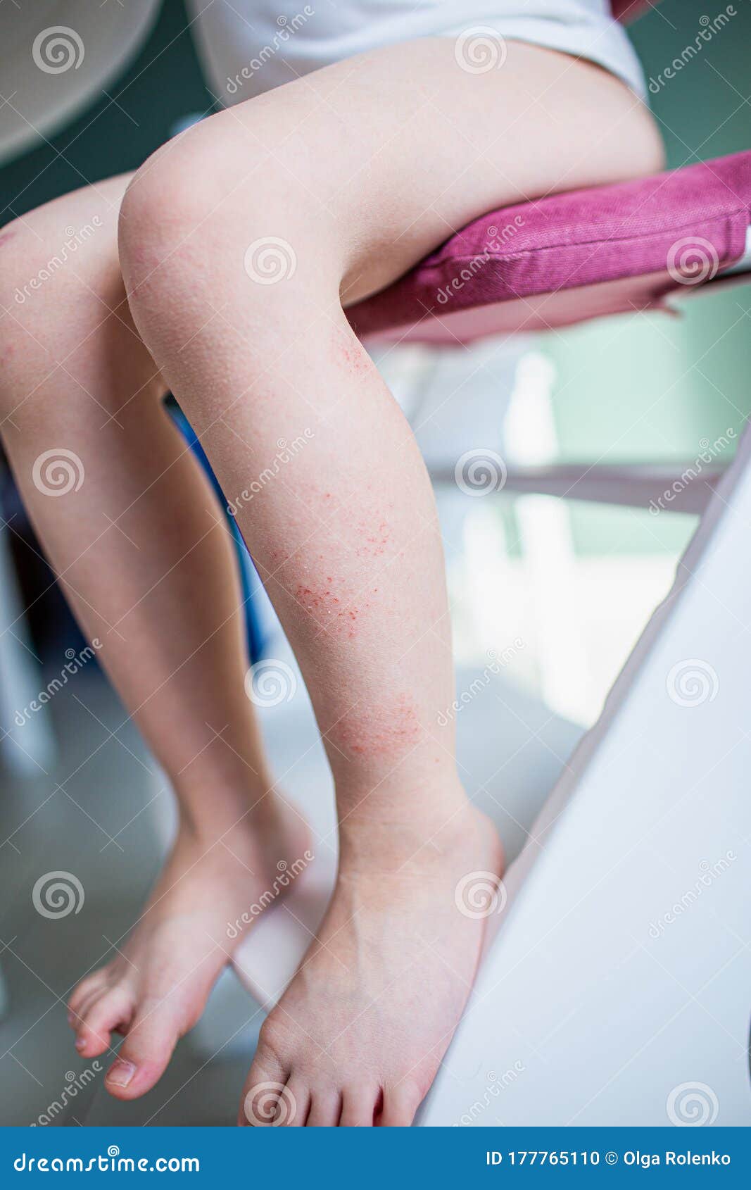 Closeup Eczema Atopic Dermatitis Symptom with Infected Skin on Child