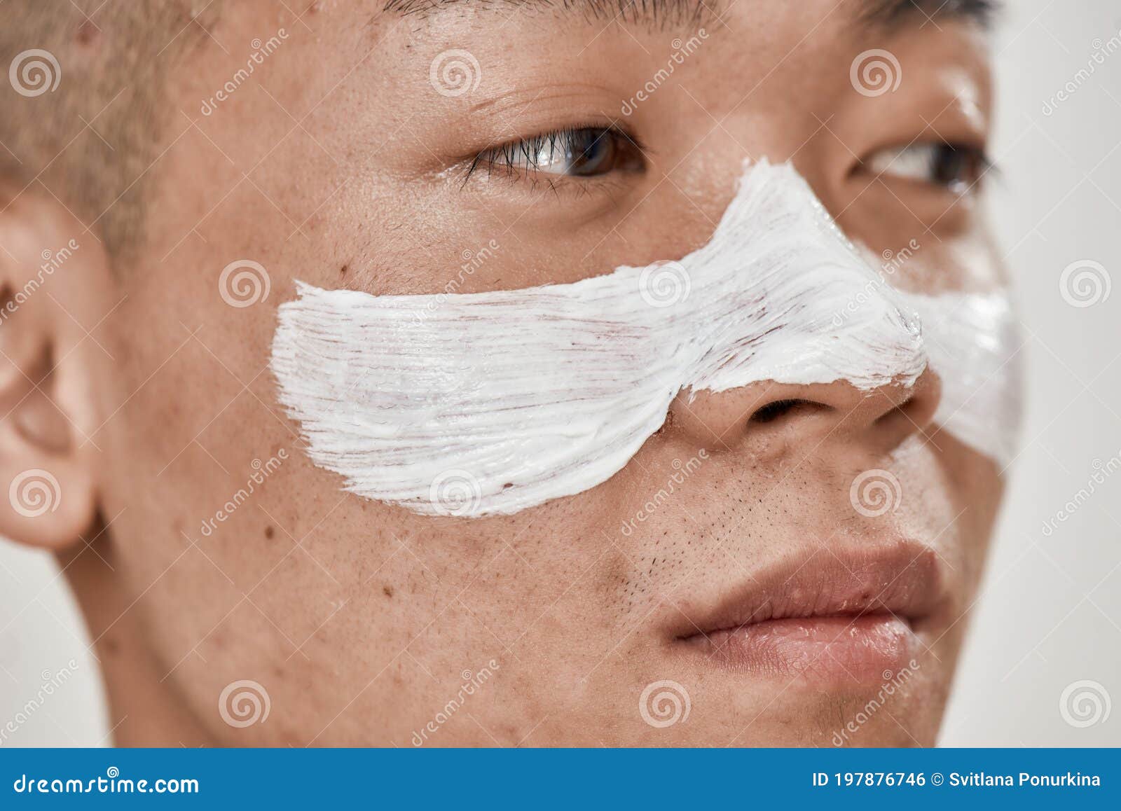 close up of face of young asian man with problematic skin and hyperpigmentation applied mask on his face, looking away