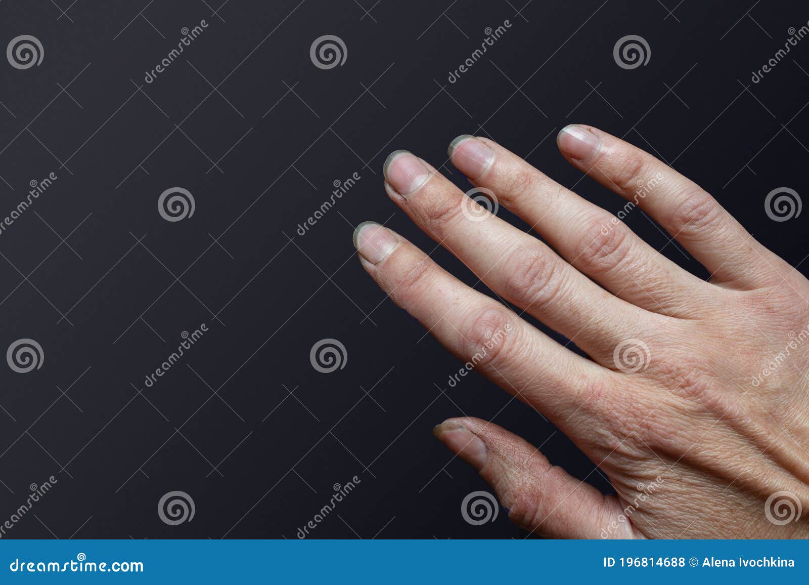 Close-up of Female Caucasian Hand with Dirty Brittle Nails, Broken ...