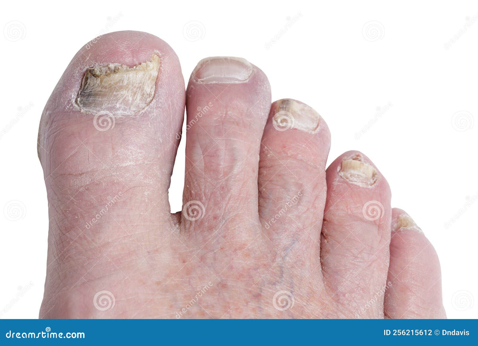 Bad foot skin bacterial fungal infection with damaged nail close up. Stock  Photo | Adobe Stock