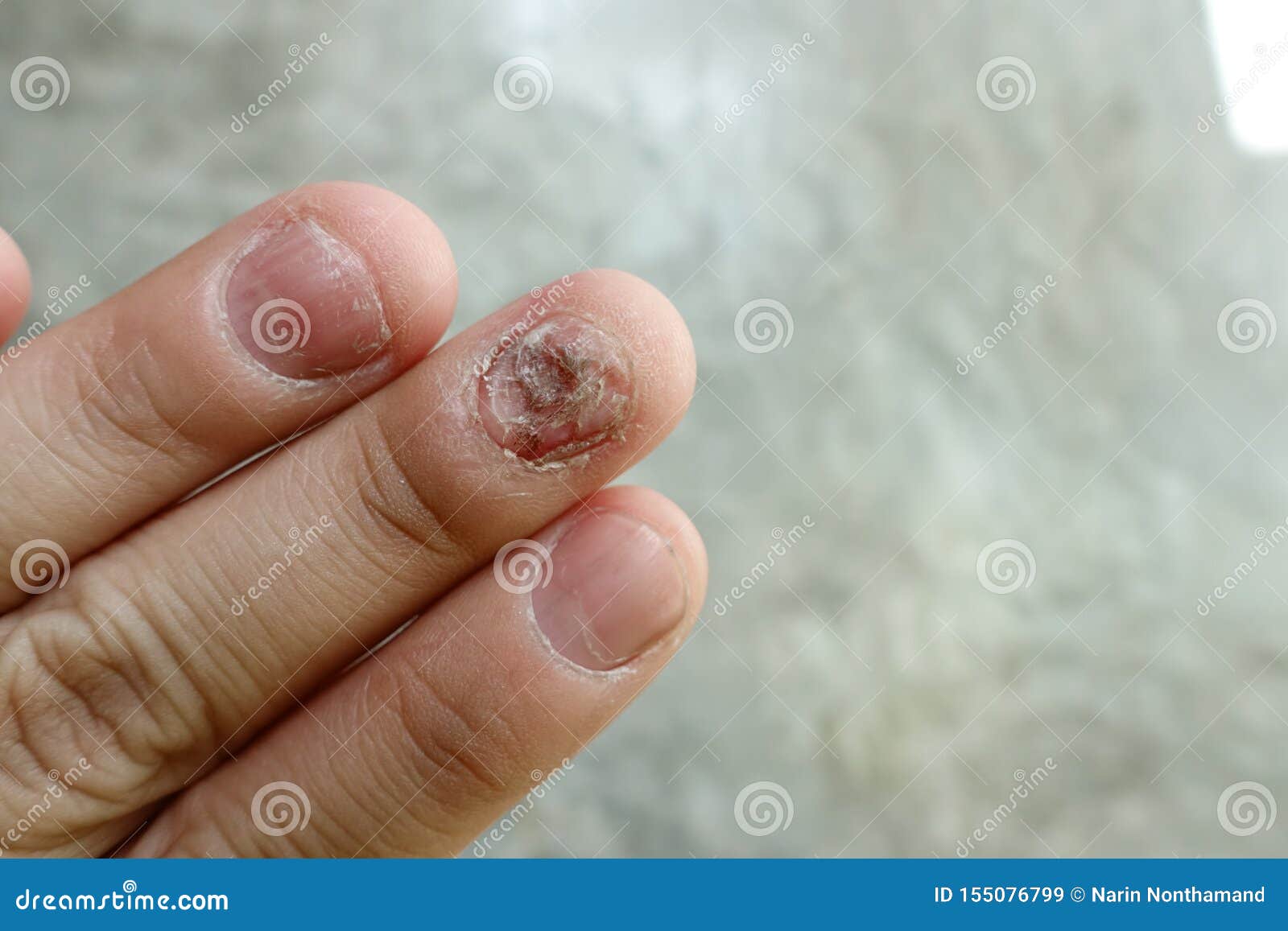 Big Close Up Of Fungus Infection On Nails Hand Finger With Onychomycosis  Fungal Infection On Nails Stock Photo - Download Image Now - iStock