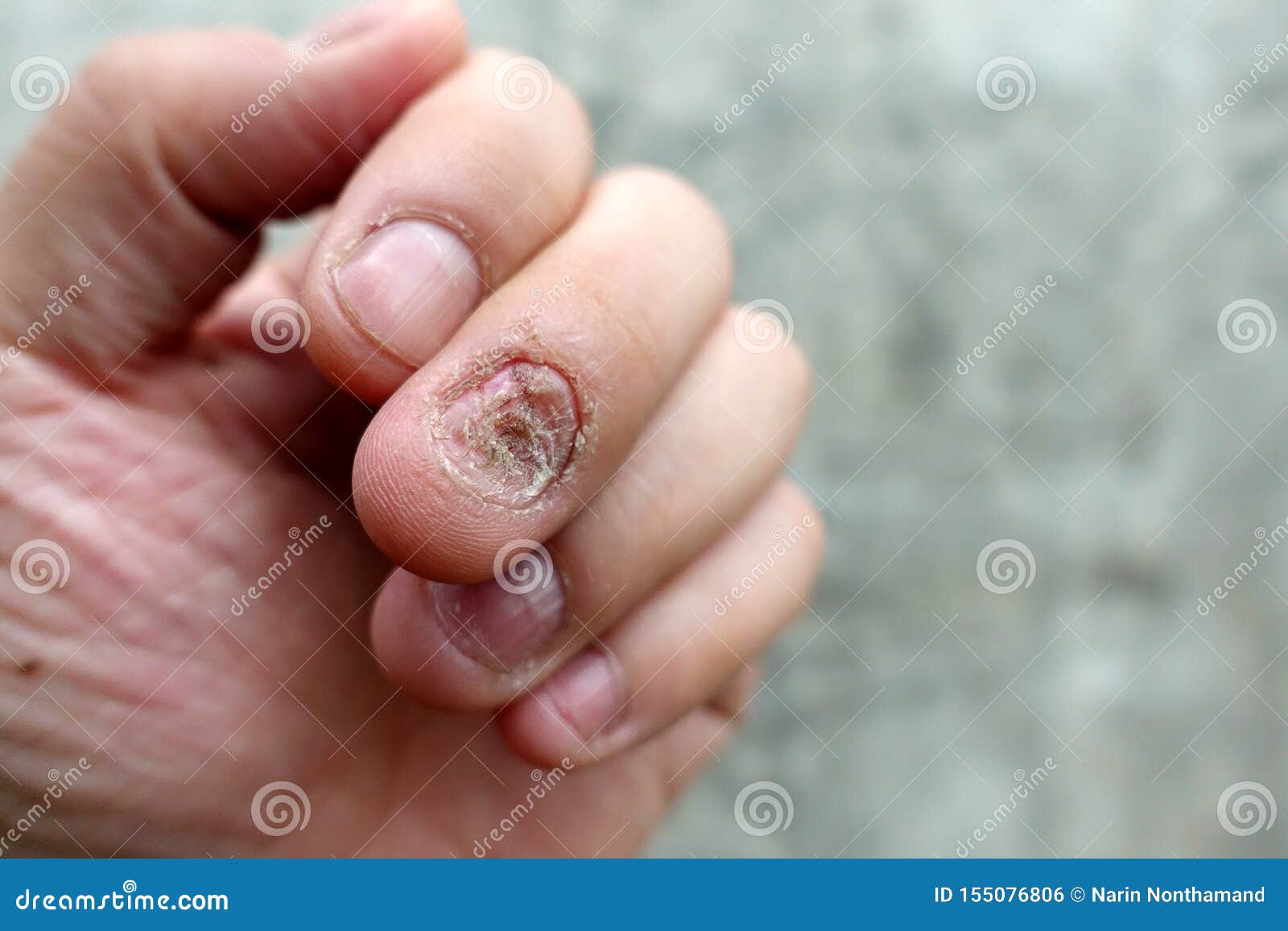 Fungal nail infection and damage on human hand. Finger with onychomycosis,  disgusting bitten fingernails on man's hand. Stock Photo by  ©n.nonthamand.gmail.com 153463136